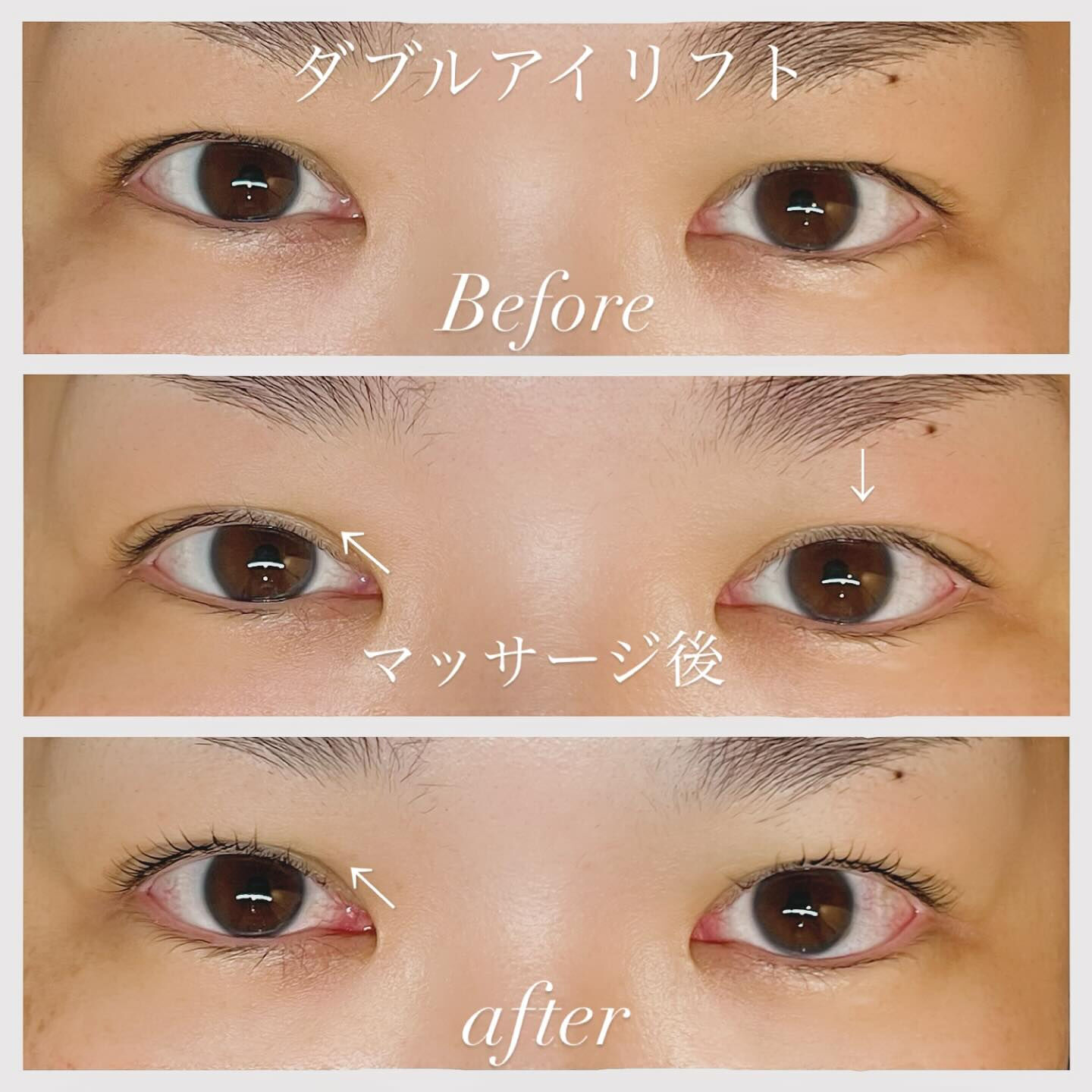 ダブルアイリフト💜