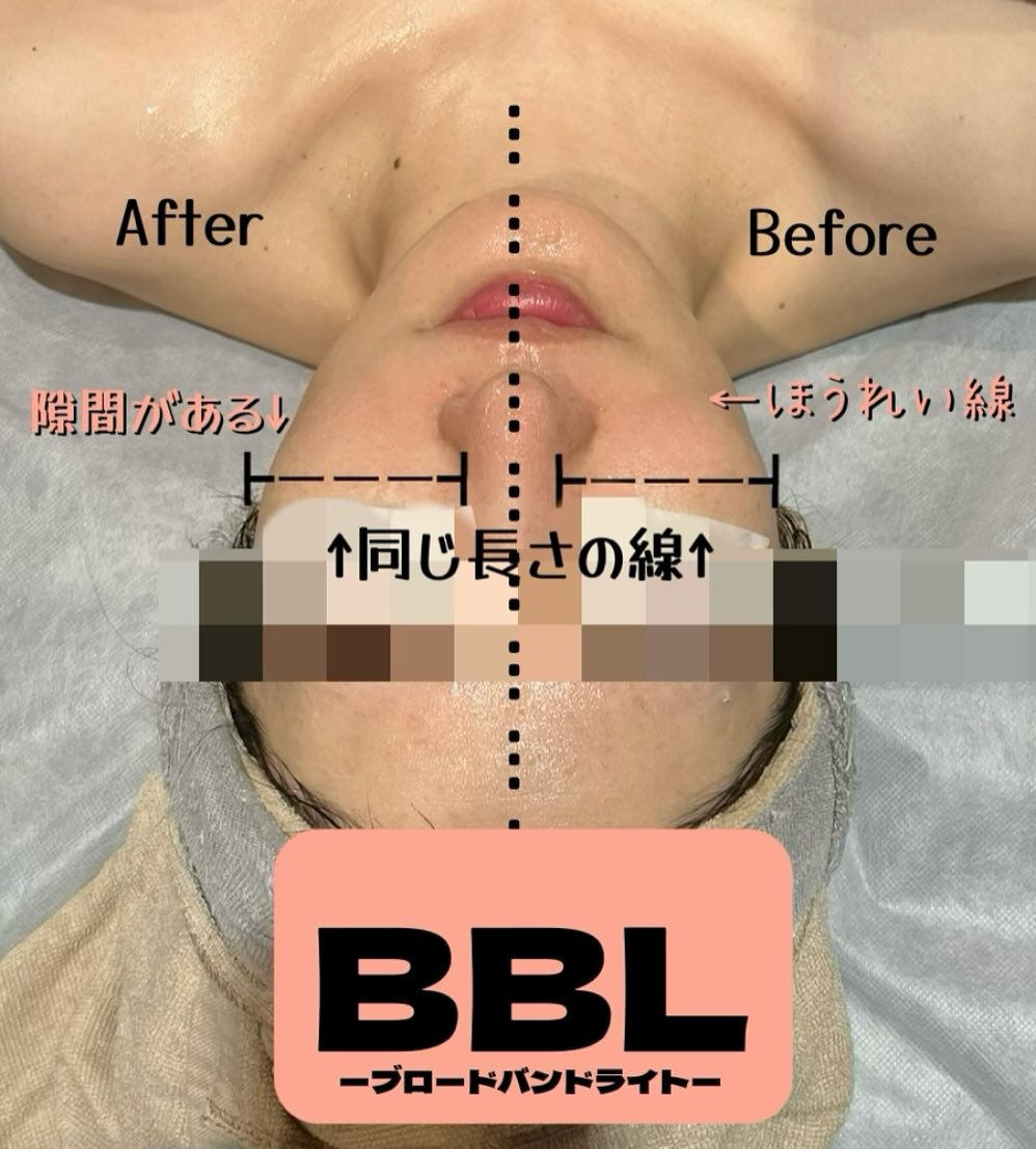 BBLブロードバンドライトは、紫外線でダメージを受けた肌を効