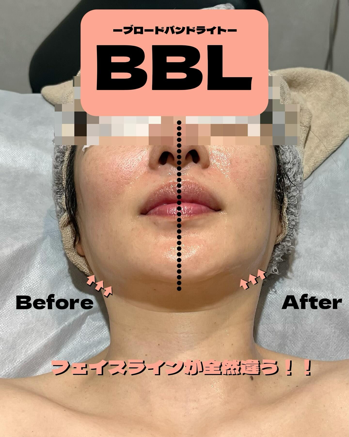 BBLブロードバンドライトは、紫外線でダメージを受けた肌を効
