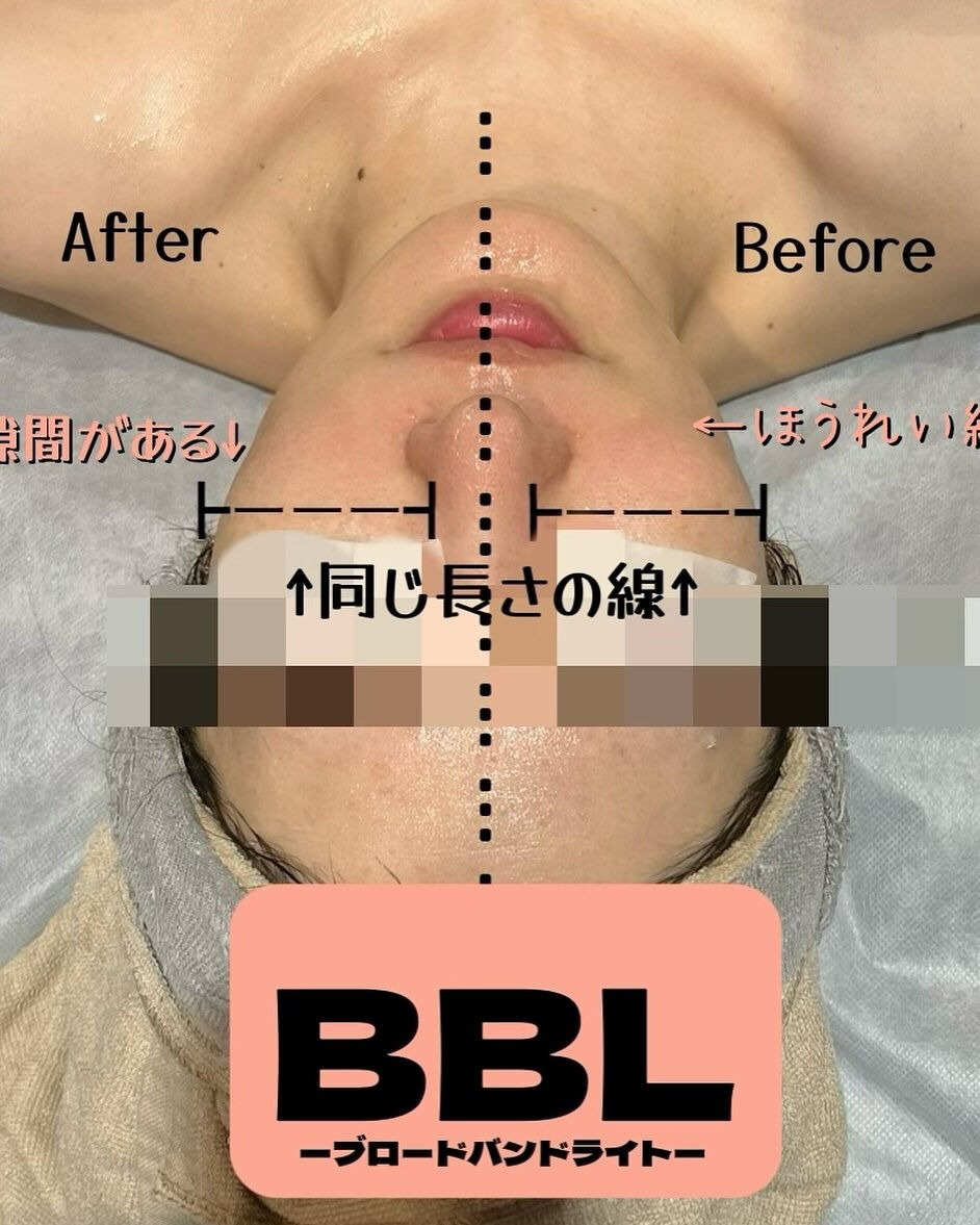 BBLブロードバンドライトは、紫外線でダメージを受けた肌を効