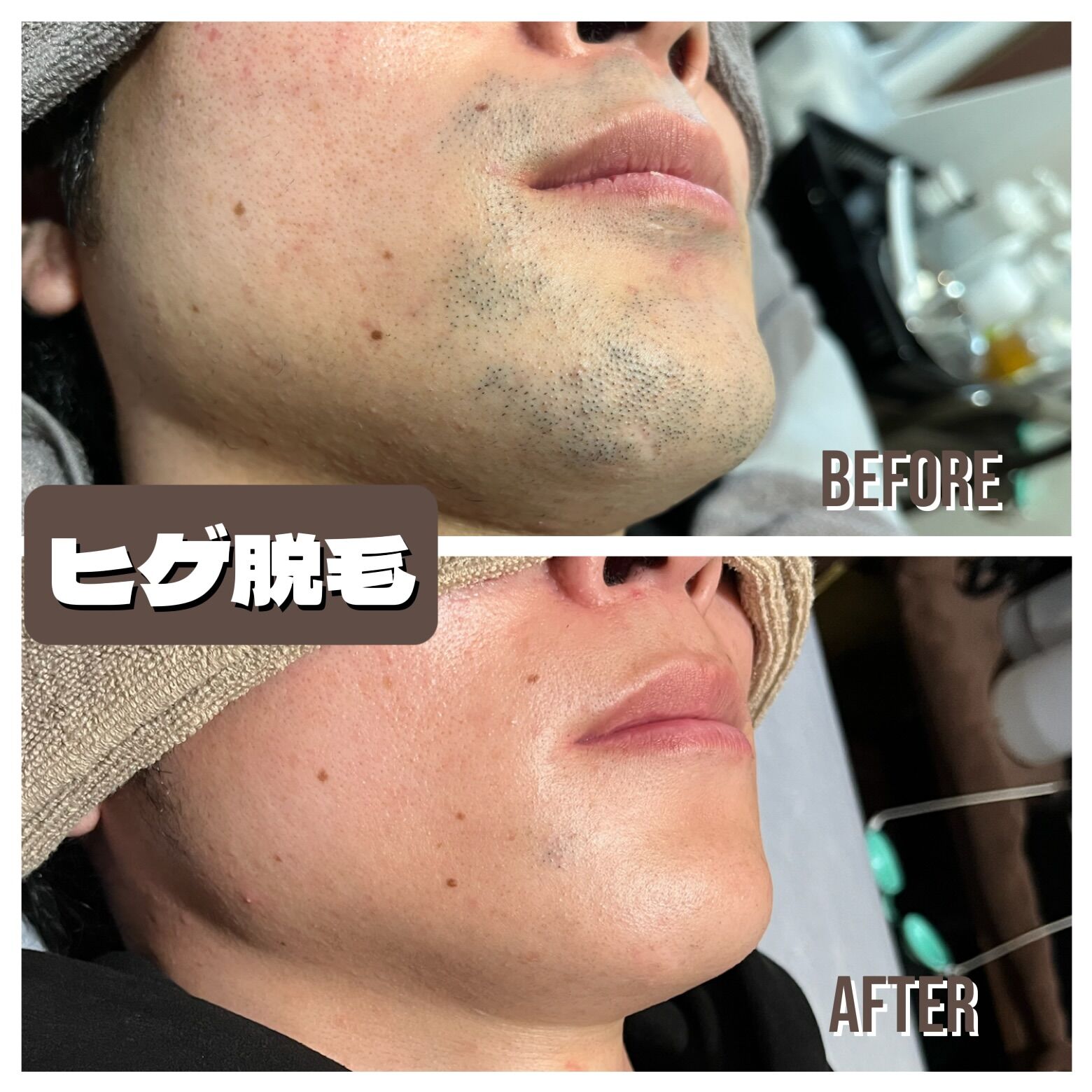 メンズ脱毛1番人気は、、、