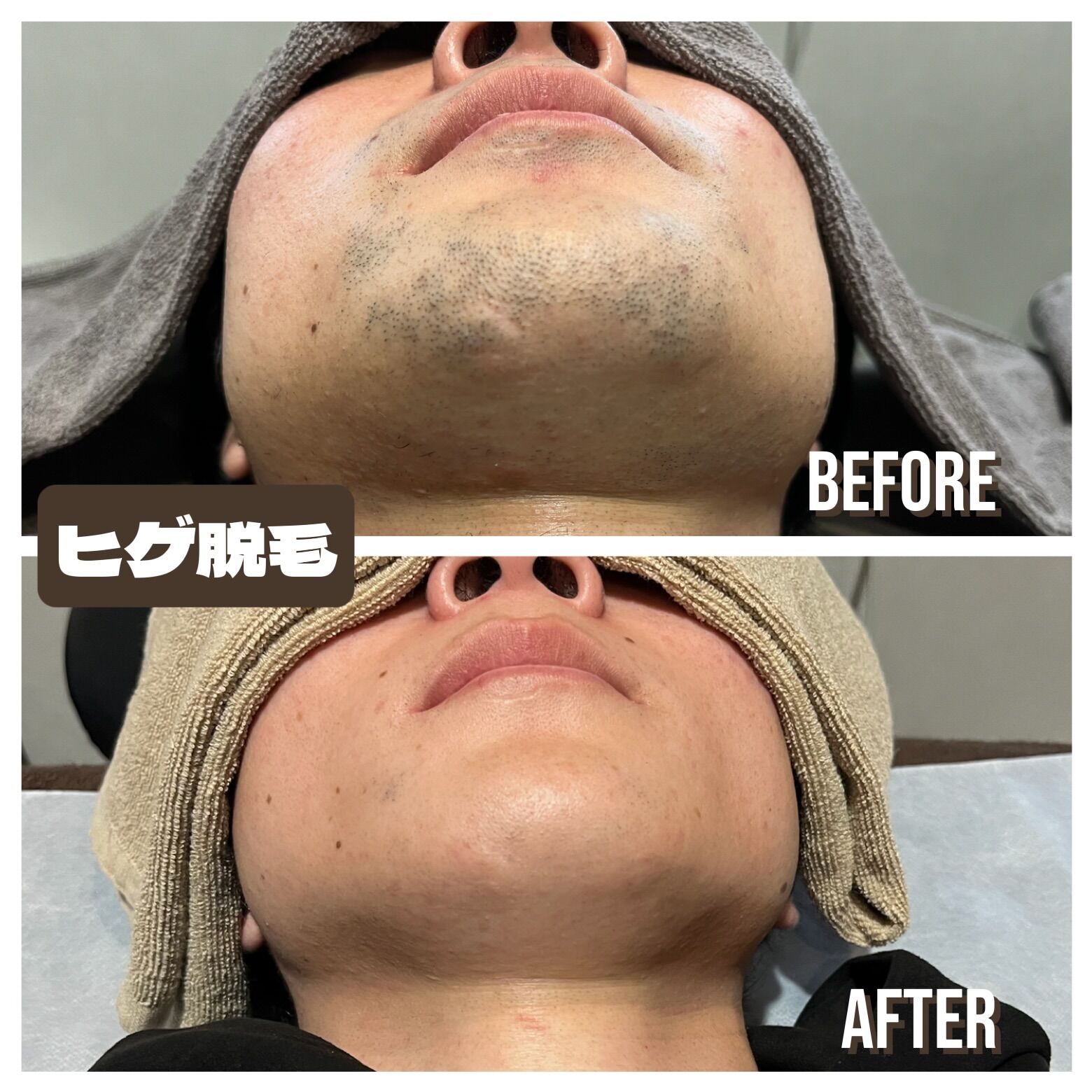 メンズ脱毛1番人気は、、、