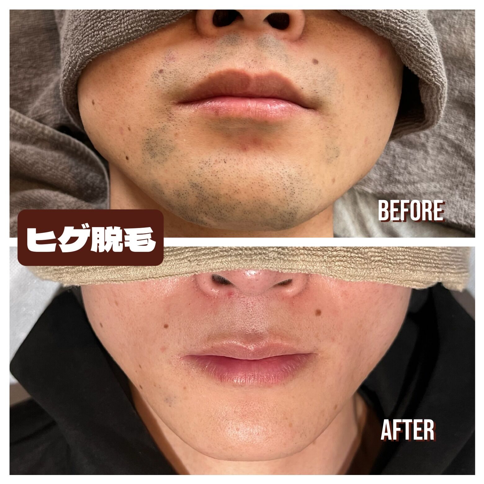 メンズ脱毛1番人気は、、、