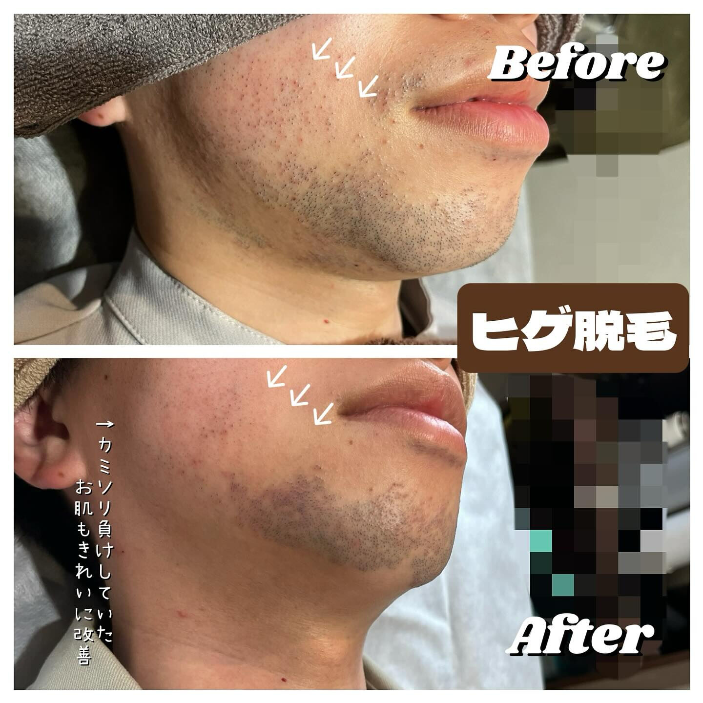 ヒゲ脱毛のお客様😎