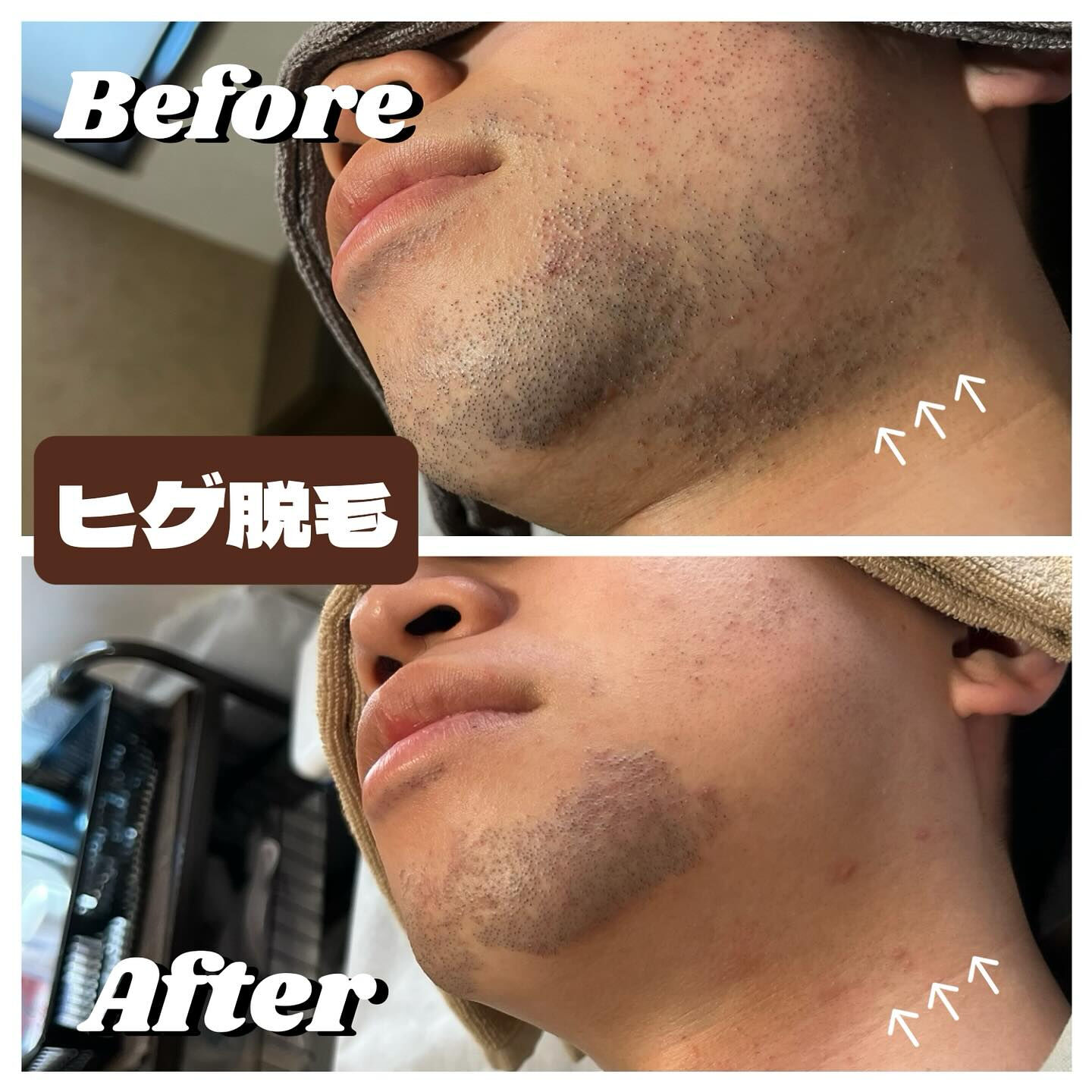 ヒゲ脱毛のお客様😎