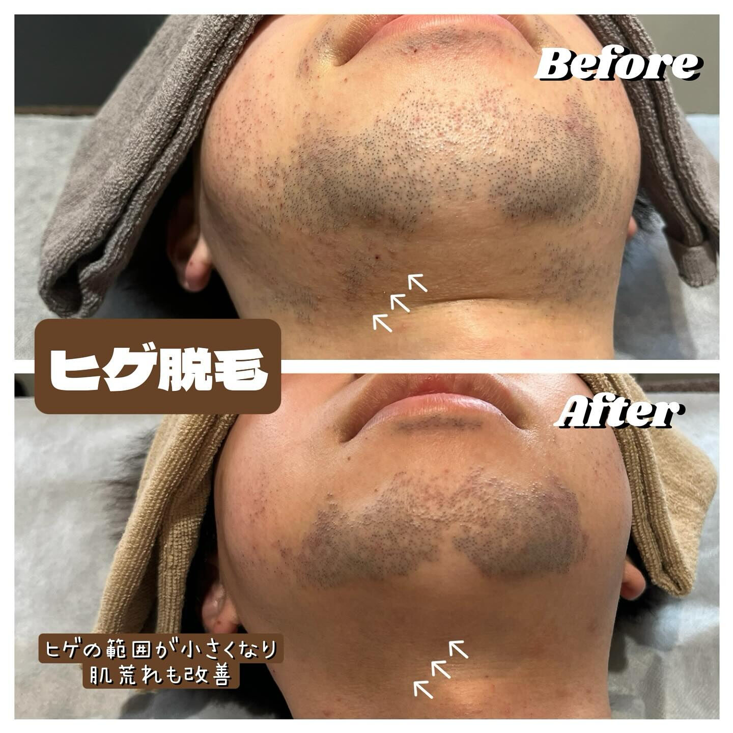 ヒゲ脱毛のお客様😎