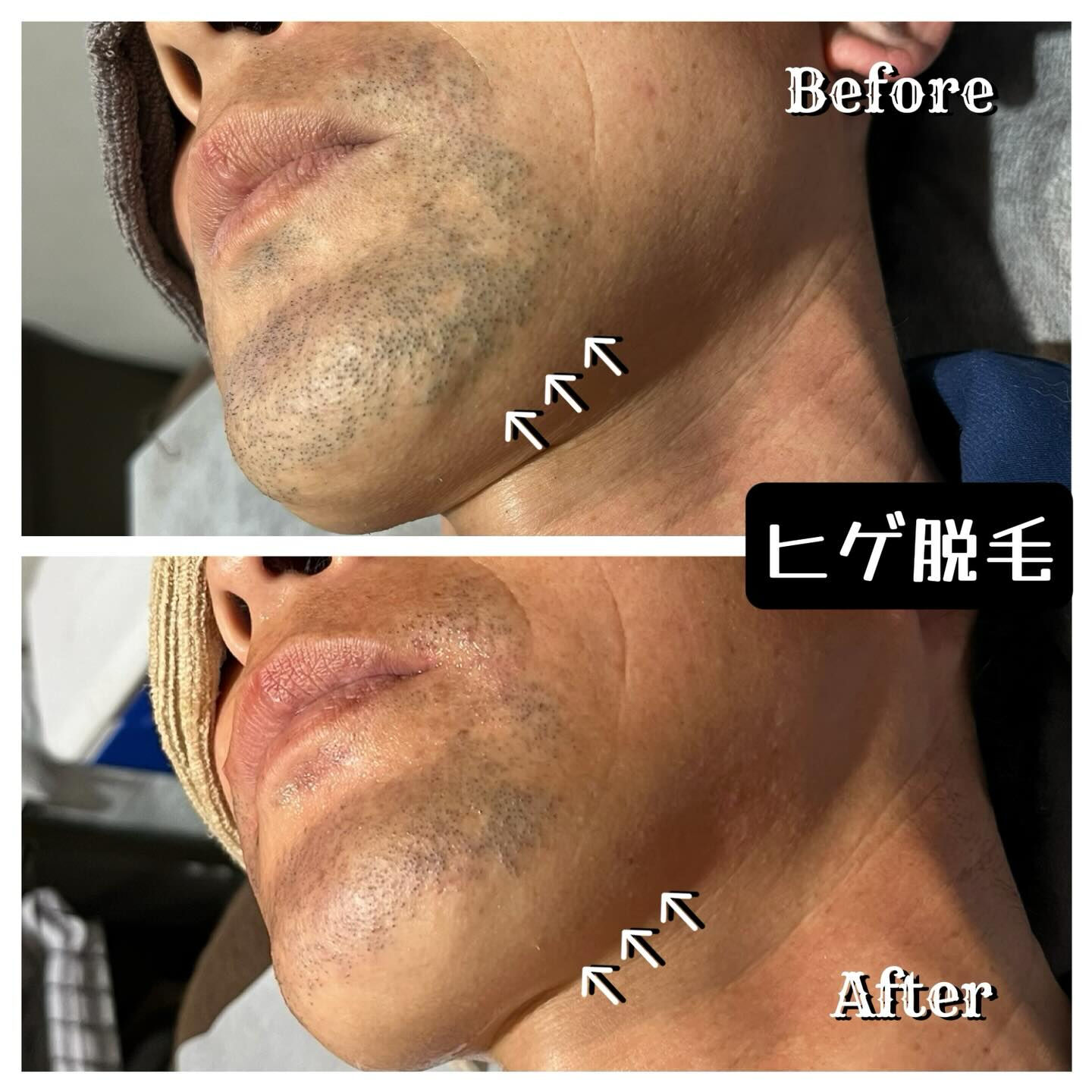毎朝、ヒゲ剃りに時間を奪われている皆様へ⏰✂️ 