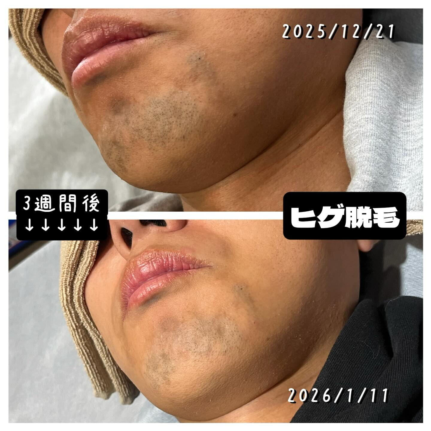 ヒゲ脱毛の効果を一度で実感できるチャンスです💡✨