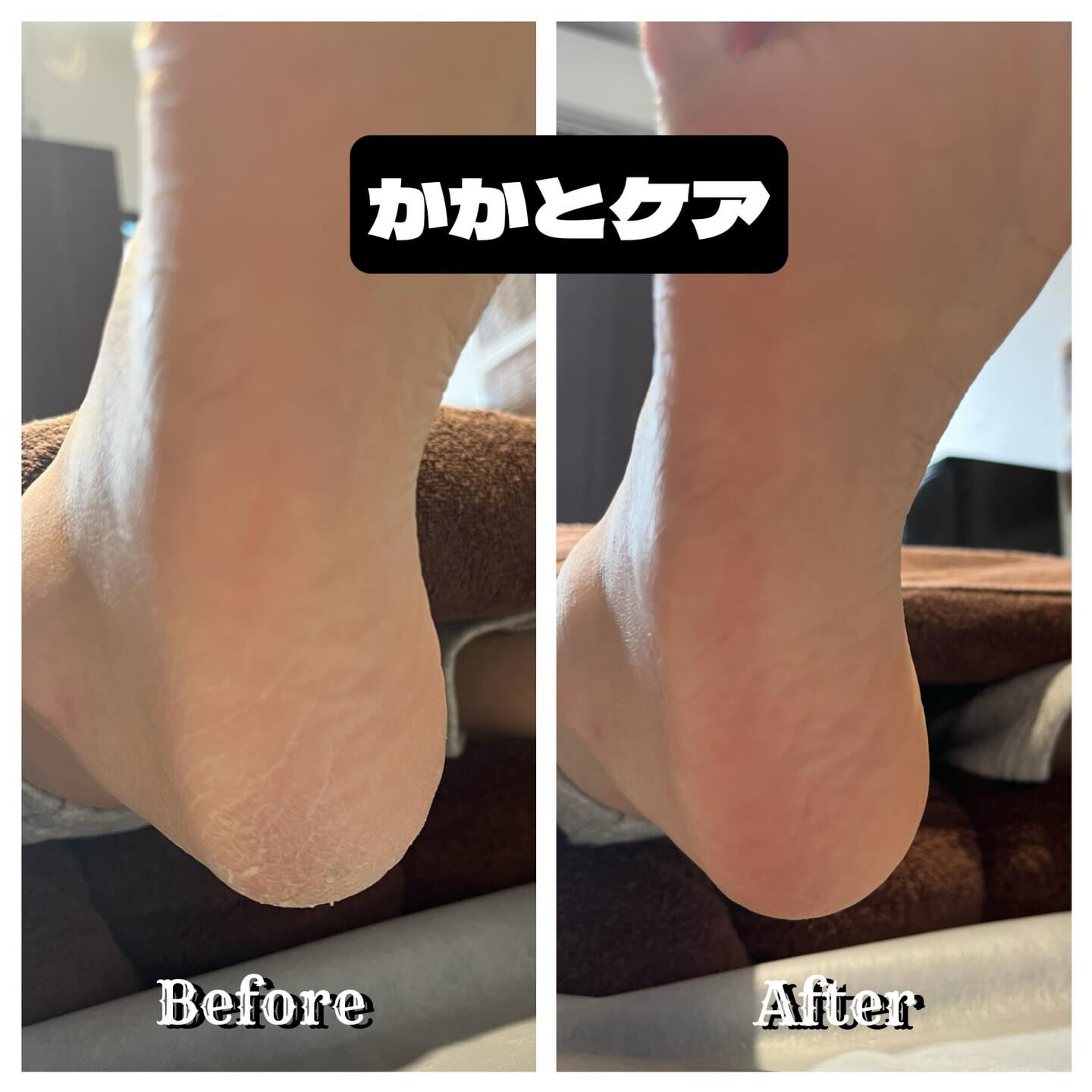 赤ちゃんのようにふわふわのかかとを手に入れませんか？👶✨ 