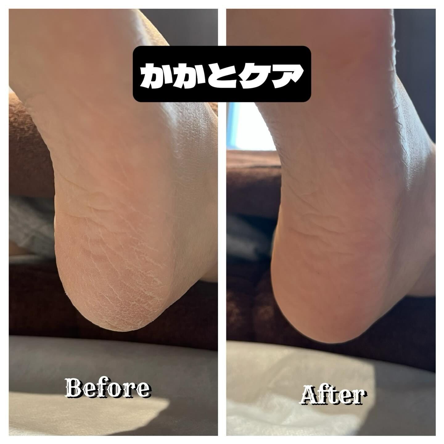 赤ちゃんのようにふわふわのかかとを手に入れませんか？👶✨ 