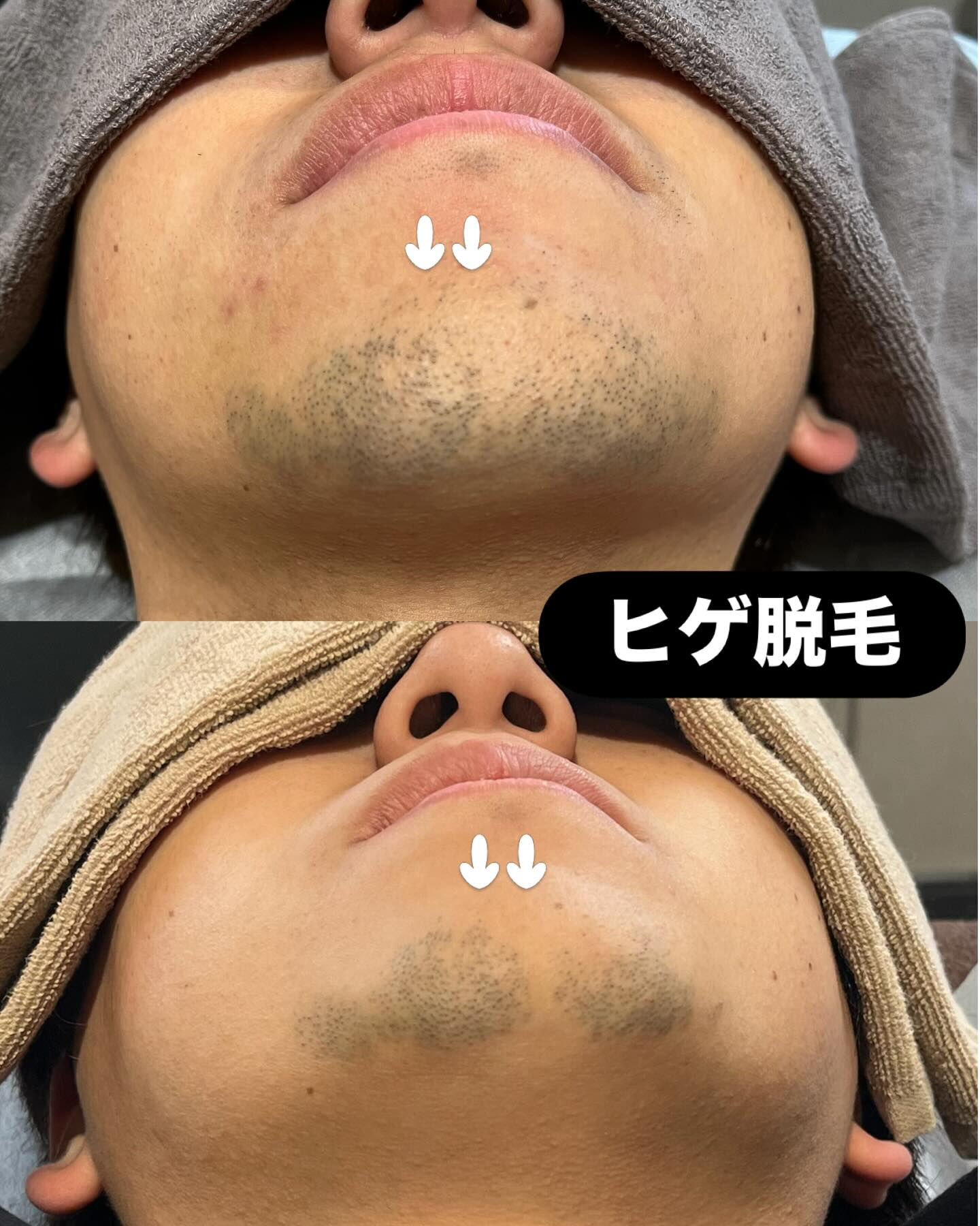 ヒゲ脱毛をすると