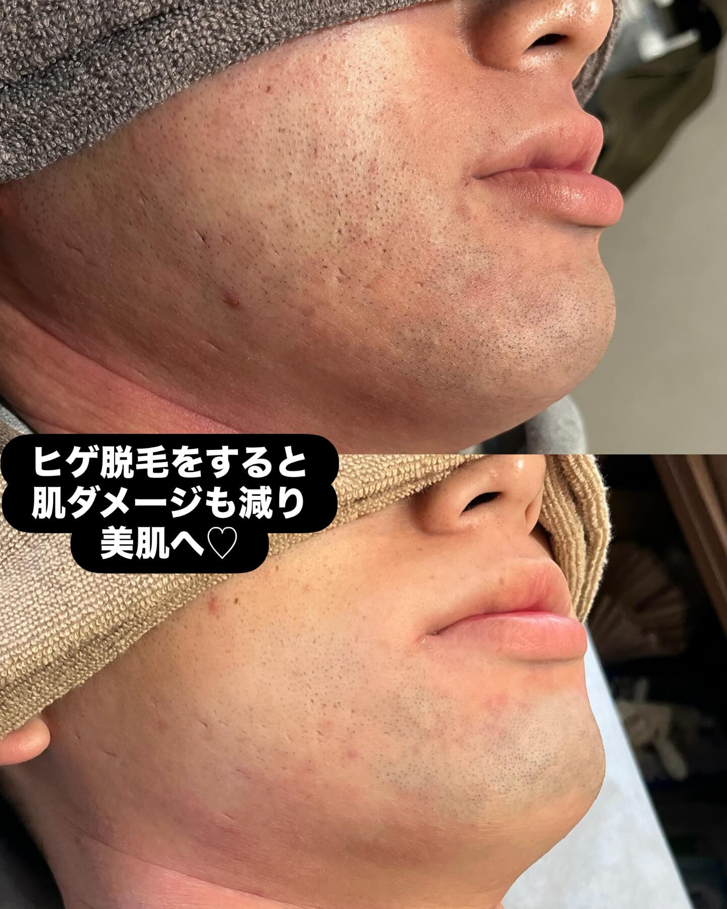 ヒゲ脱毛をすると