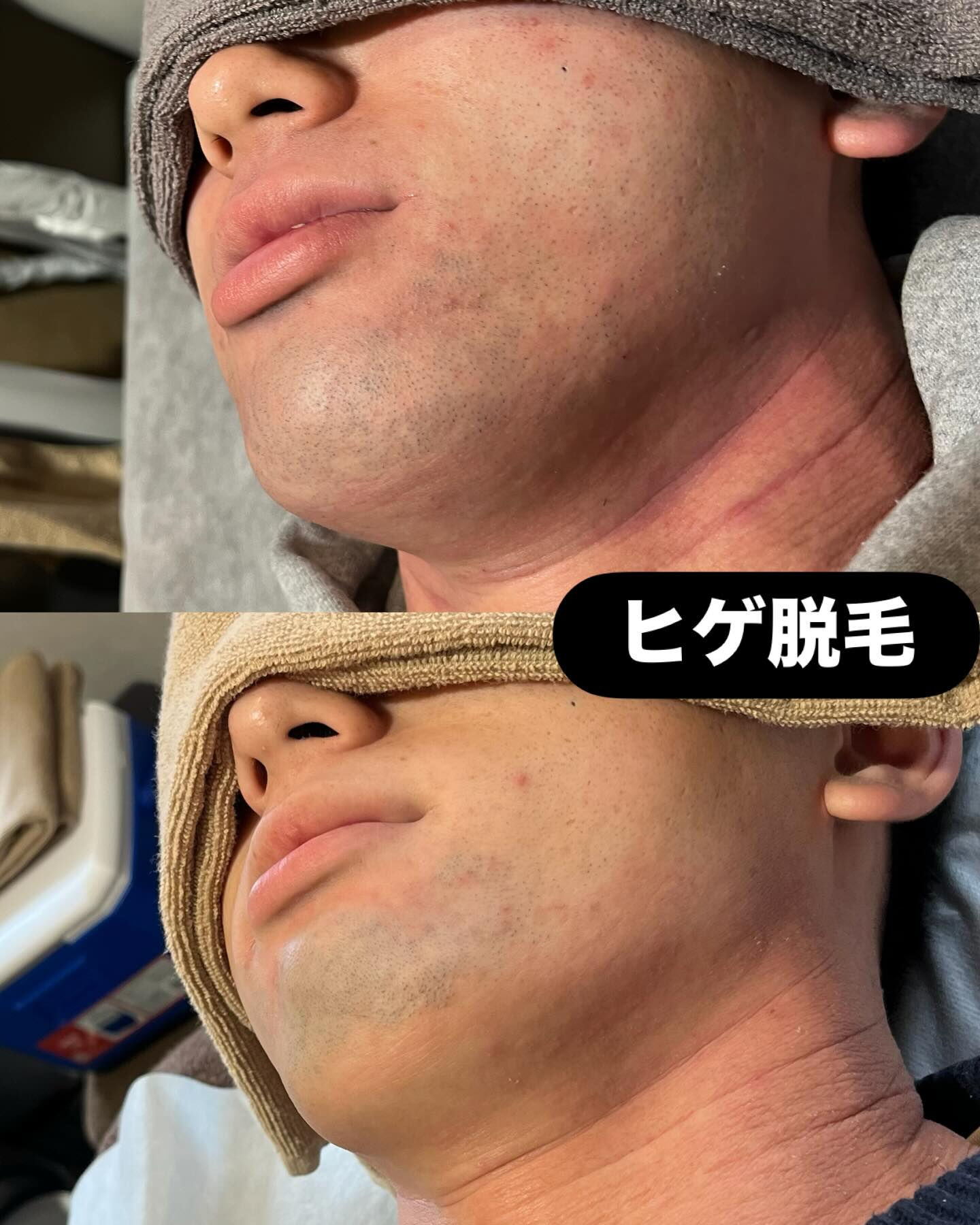 ヒゲ脱毛をすると
