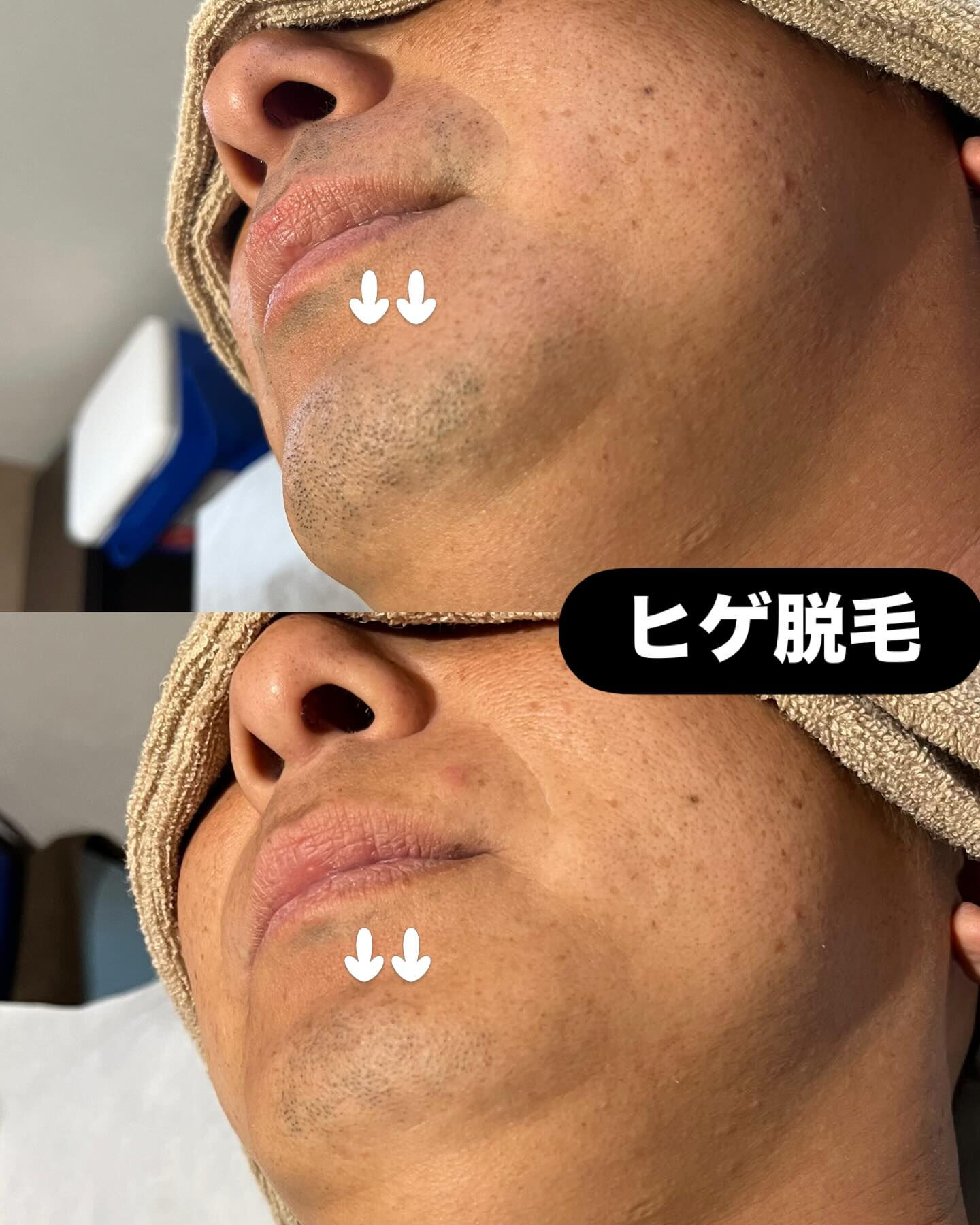 ヒゲ脱毛をすると
