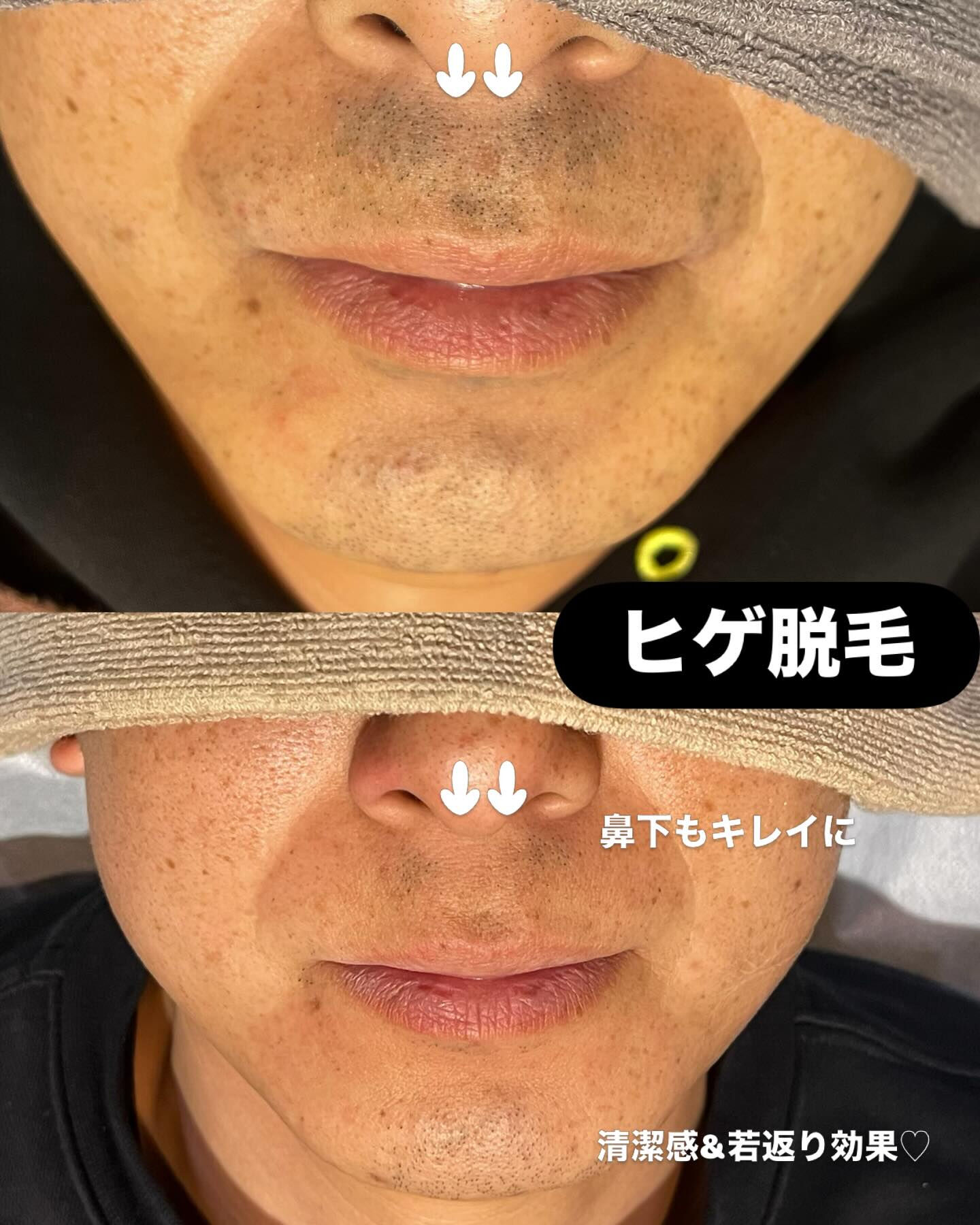 ヒゲ脱毛をすると