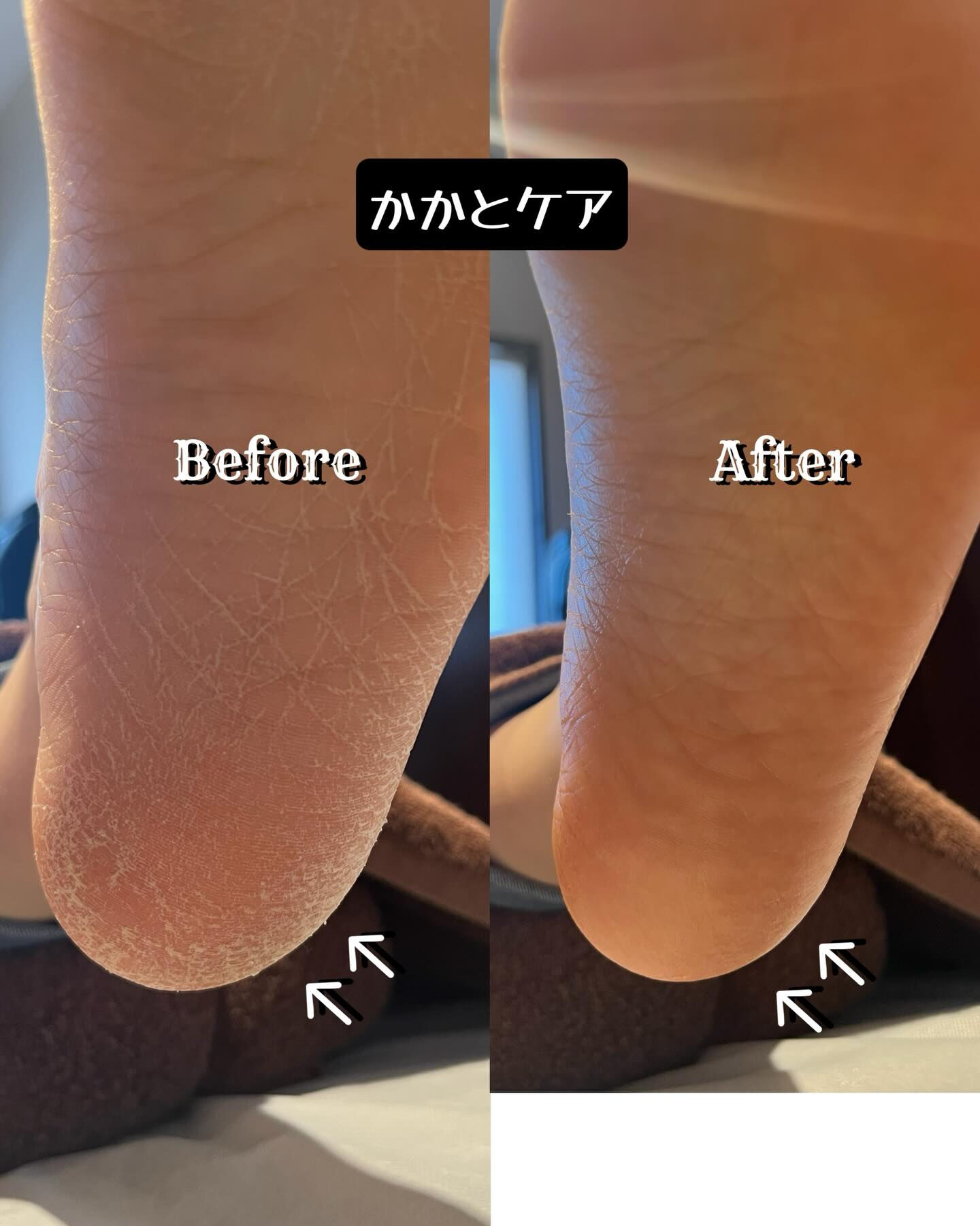 かかとの「かさつき」や「硬さ」が気になっていませんか？