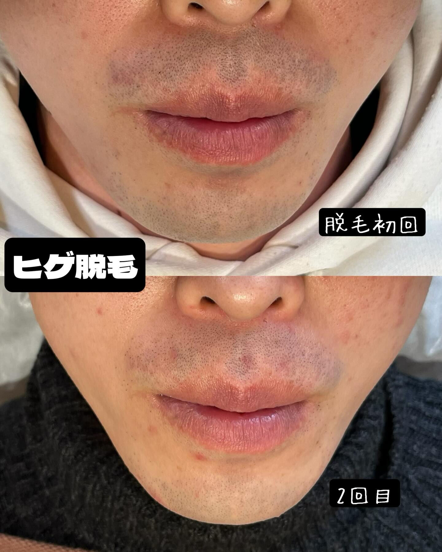 ヒゲ脱毛のお客様