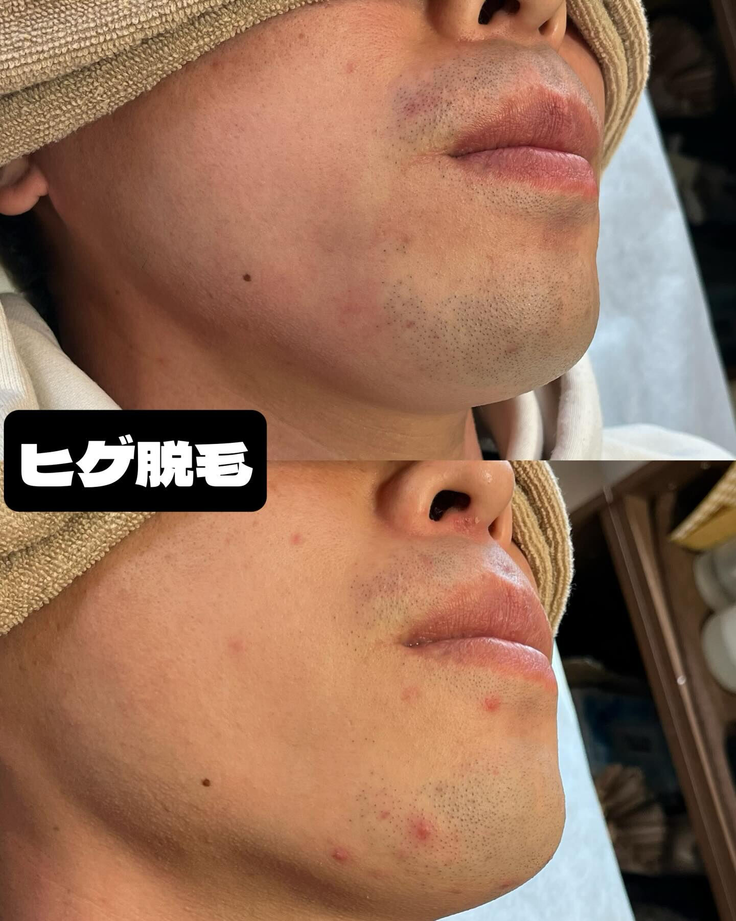 ヒゲ脱毛のお客様