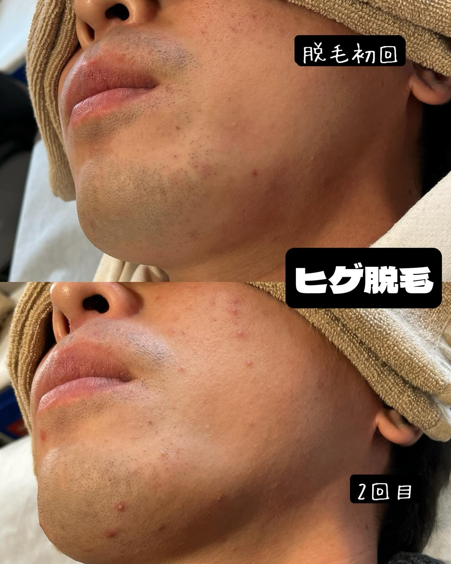 ヒゲ脱毛のお客様