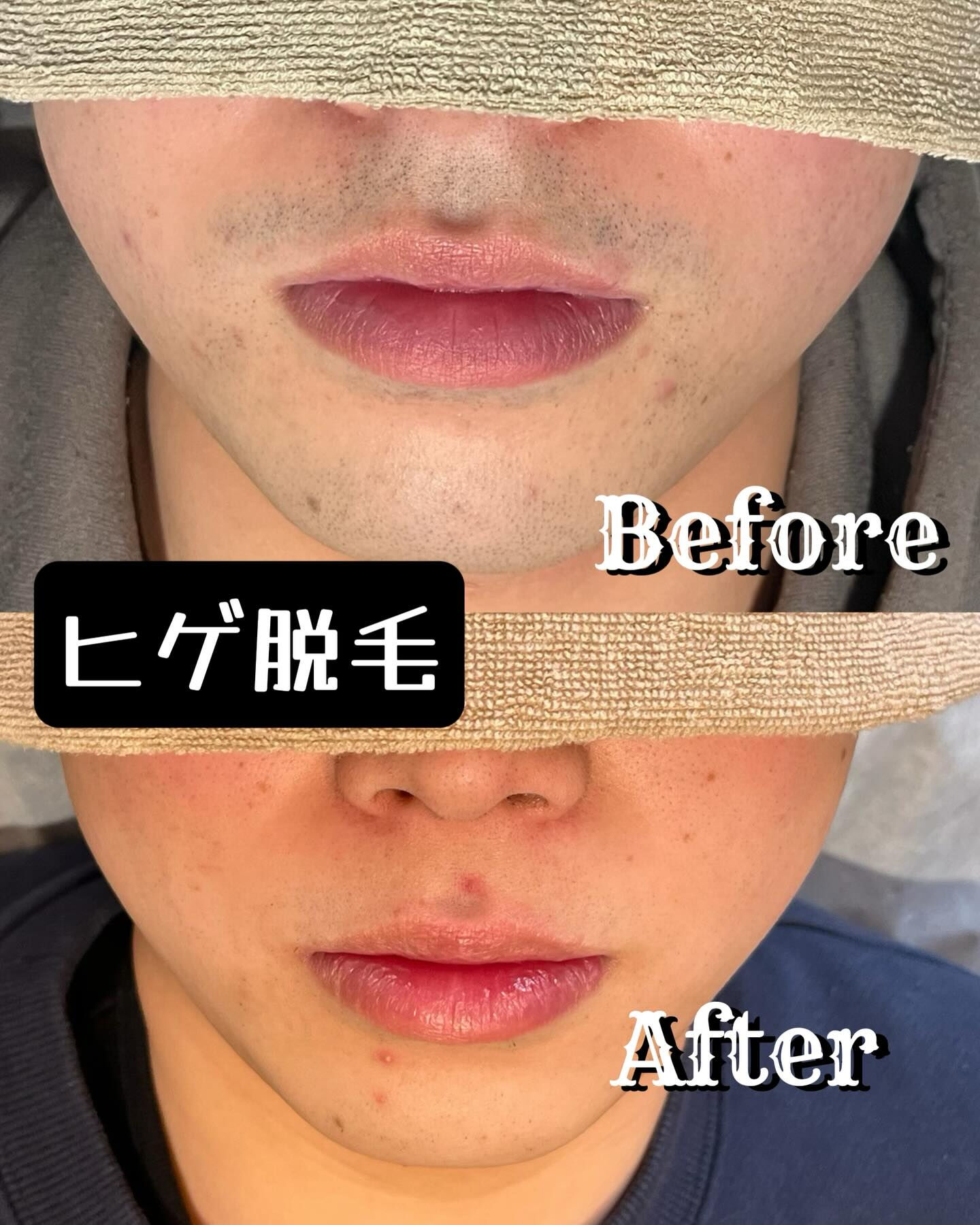✨脱毛を考えている皆様へ✨