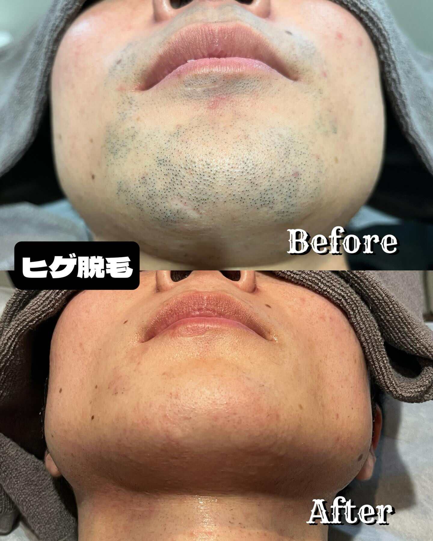 🌟ヒゲ脱毛の新時代到来！🌟