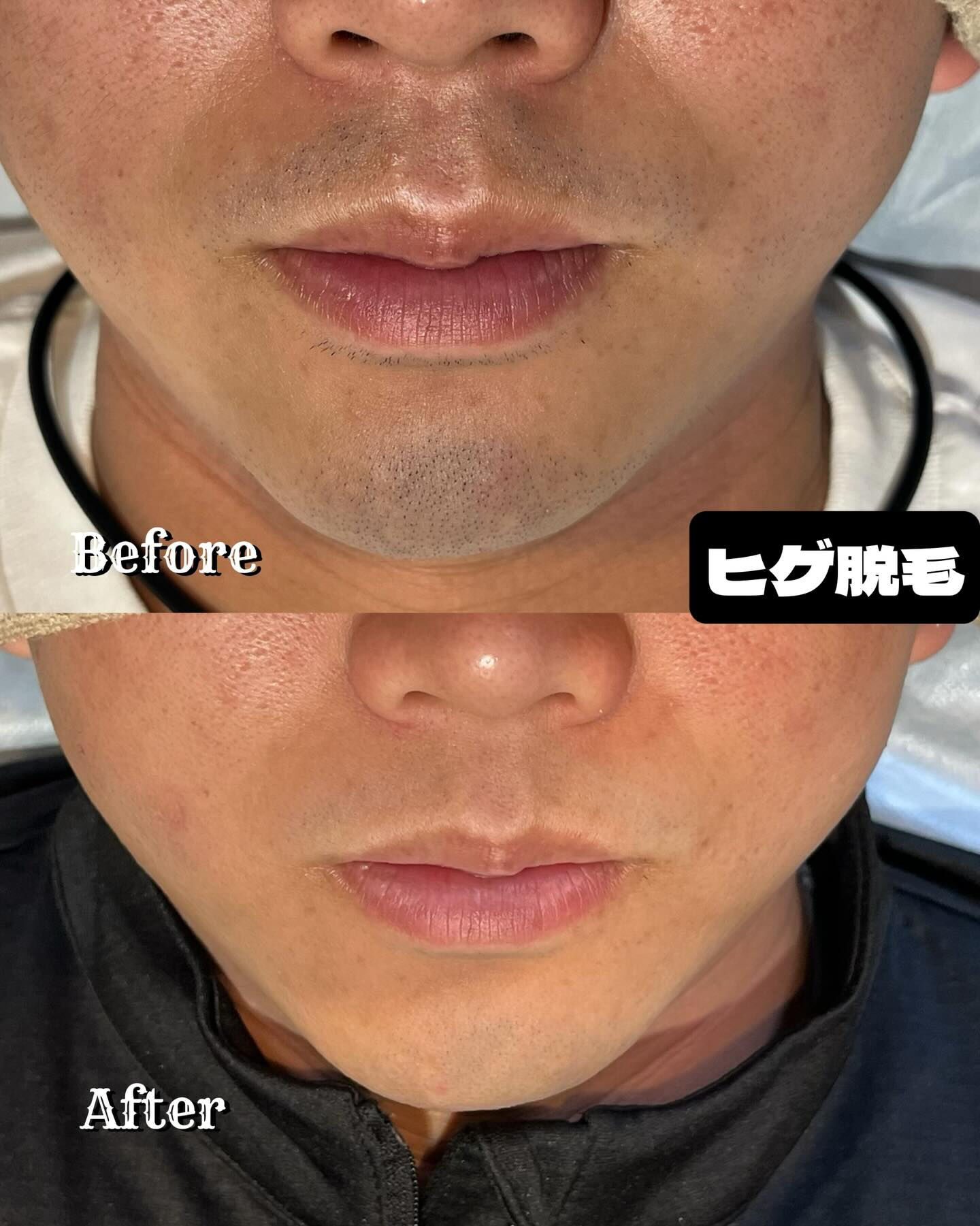 🌟ヒゲ脱毛の新時代到来！🌟