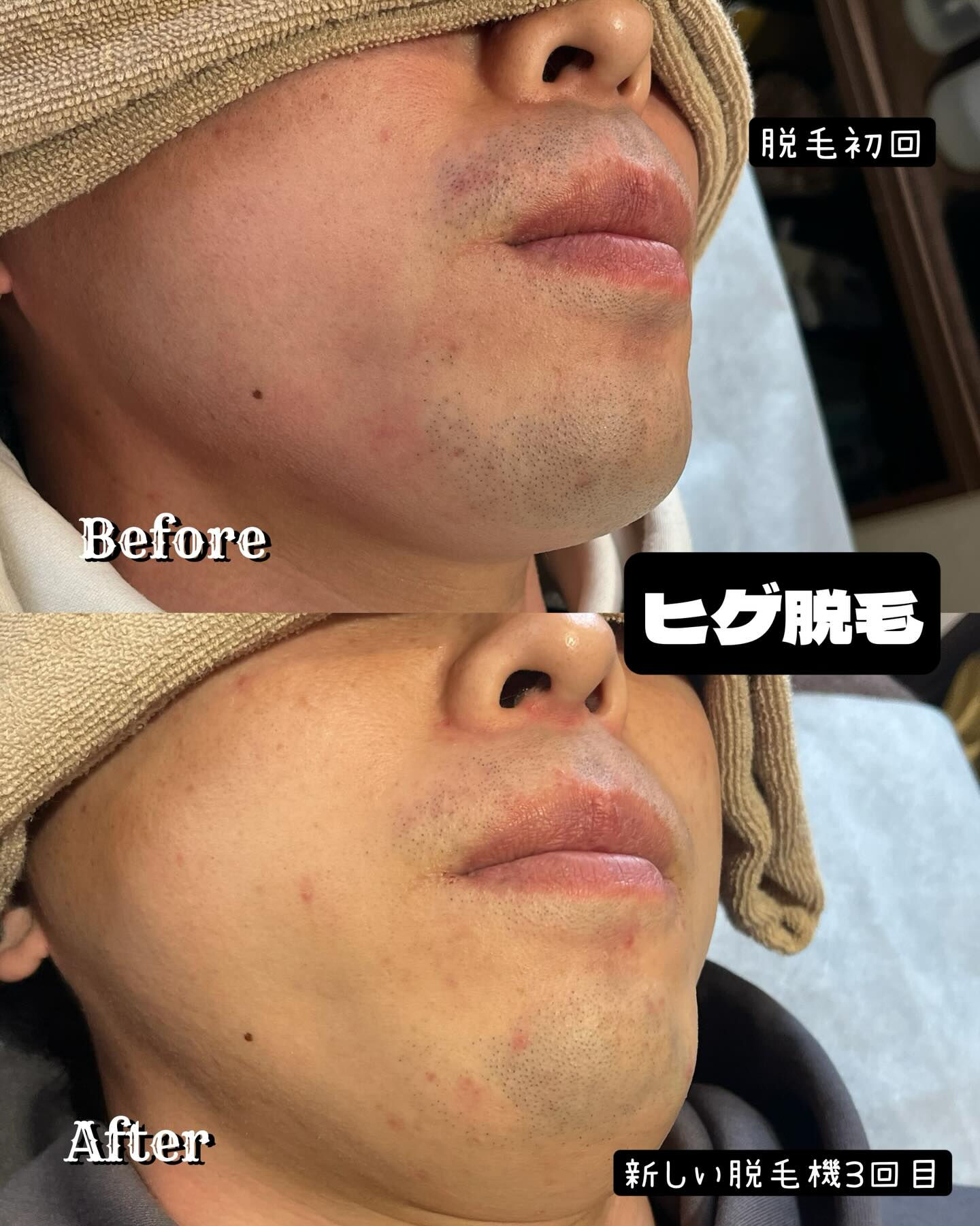 🌟ヒゲ脱毛の新時代到来！🌟