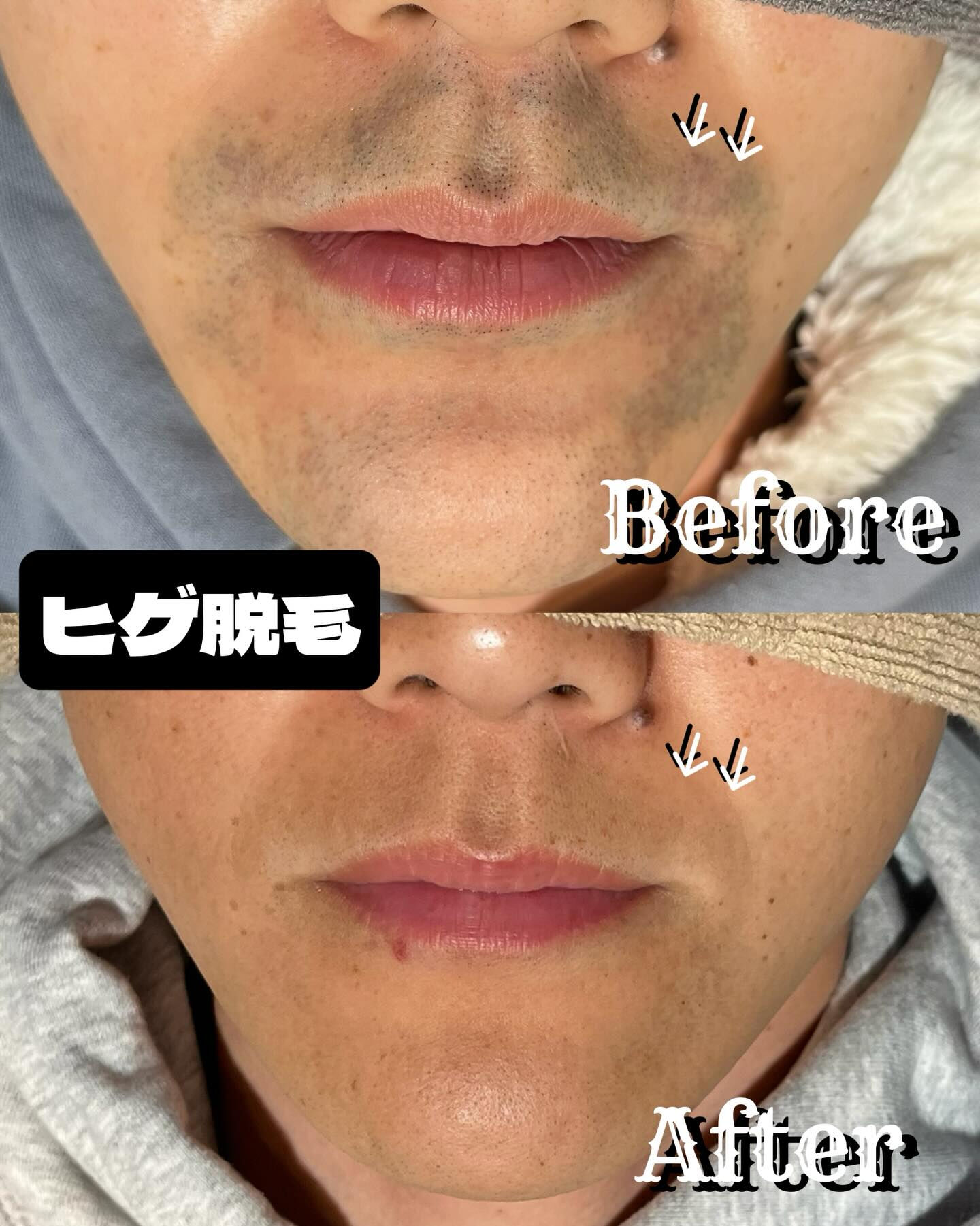 青髭が気になっている方、毎日の自己処理に疲れていませんか？🌟