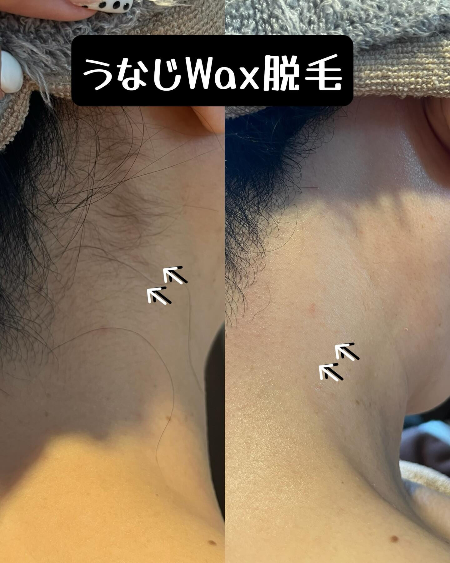 うなじのWax脱毛で、後ろ姿をさらに美しく✨