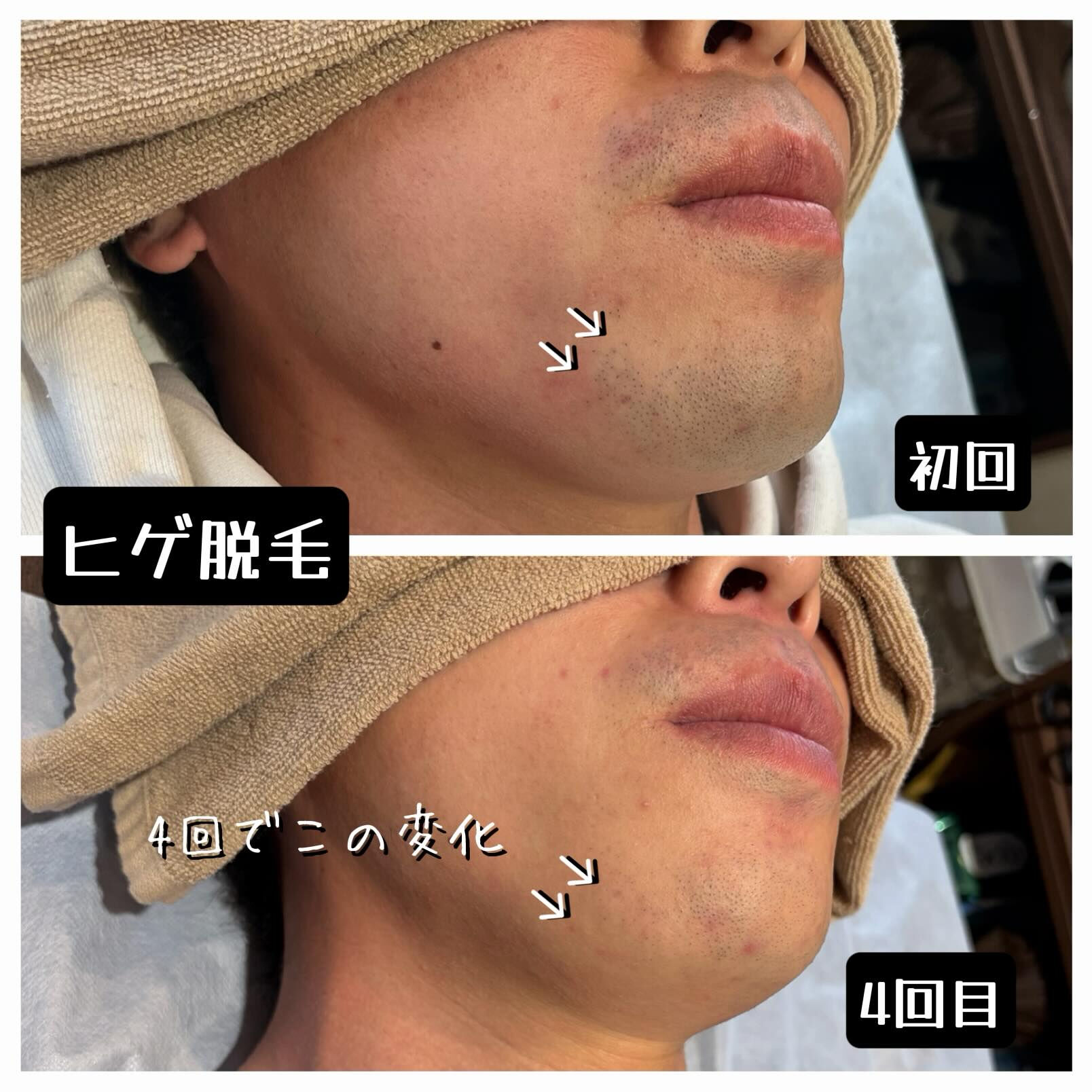 【ヒゲ脱毛 経過写真📸】