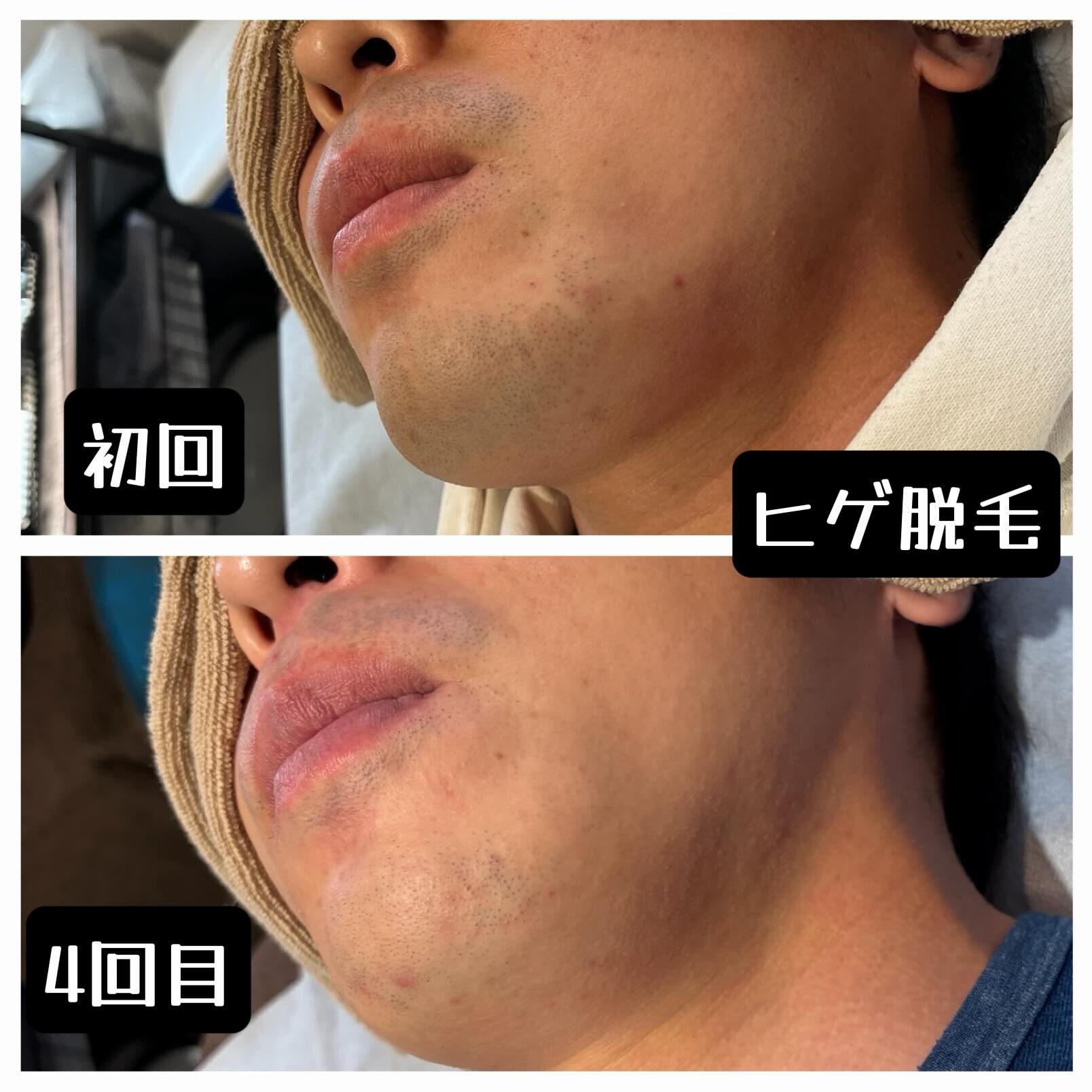 【ヒゲ脱毛 経過写真📸】