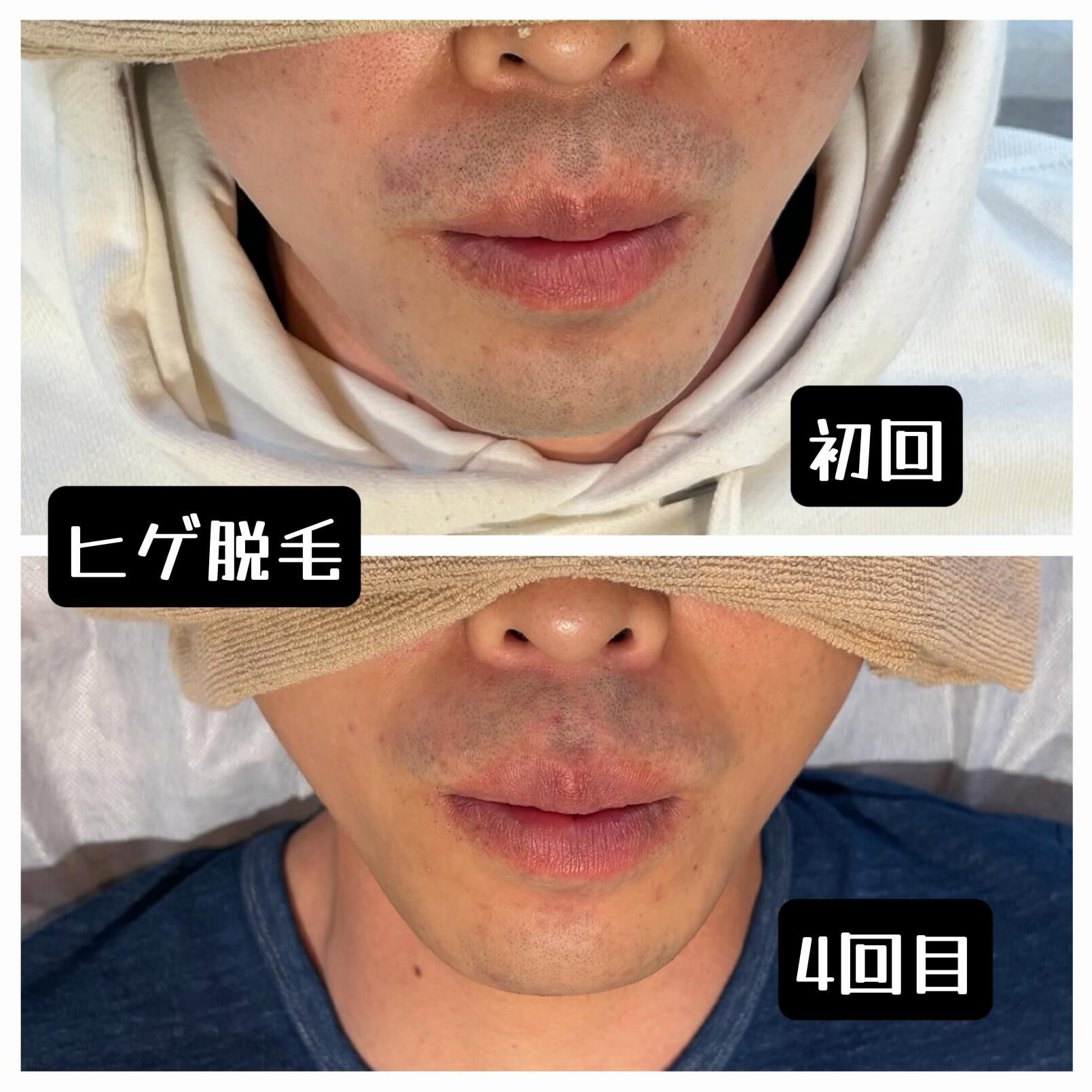【ヒゲ脱毛 経過写真📸】