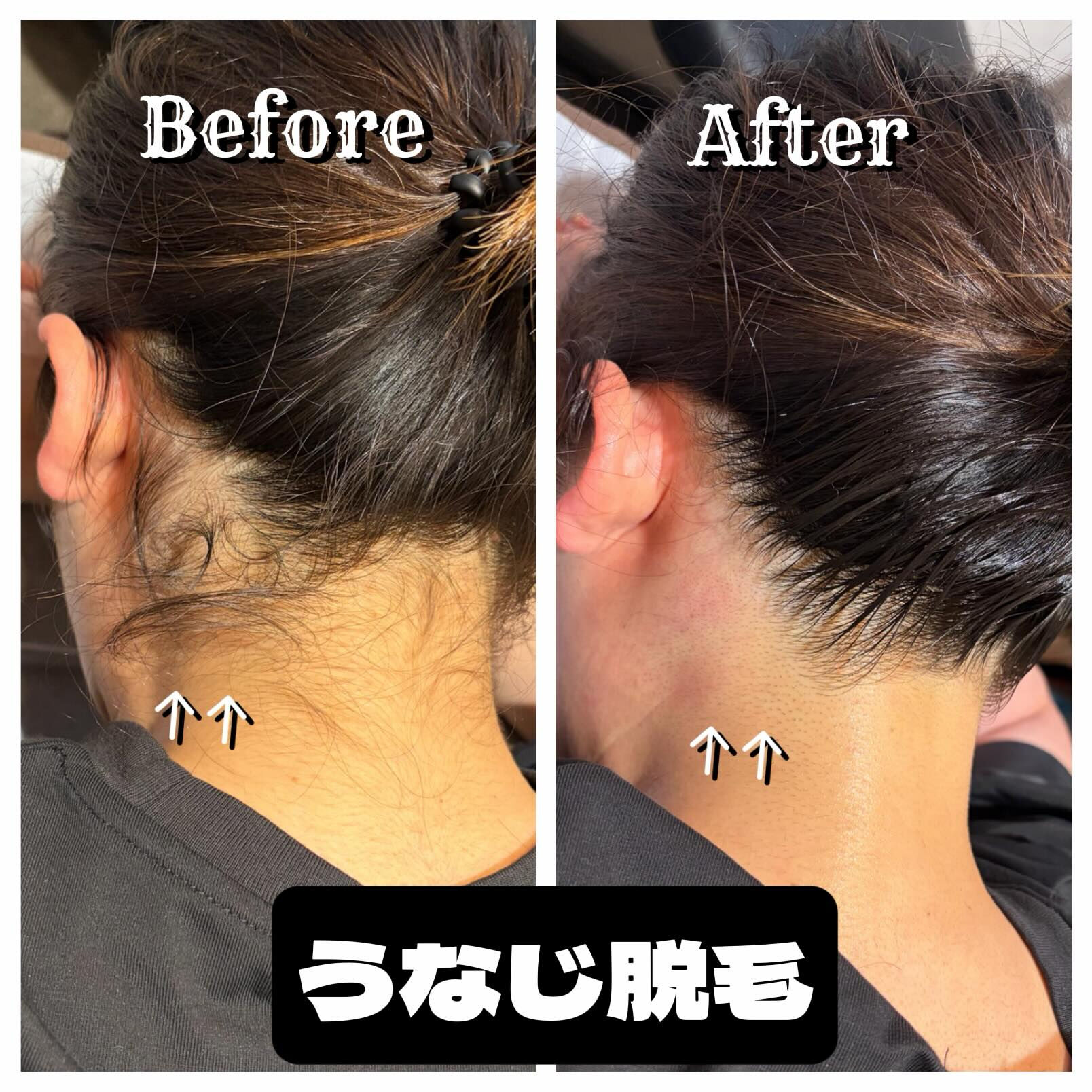 女性人気No.1✨うなじ脱毛