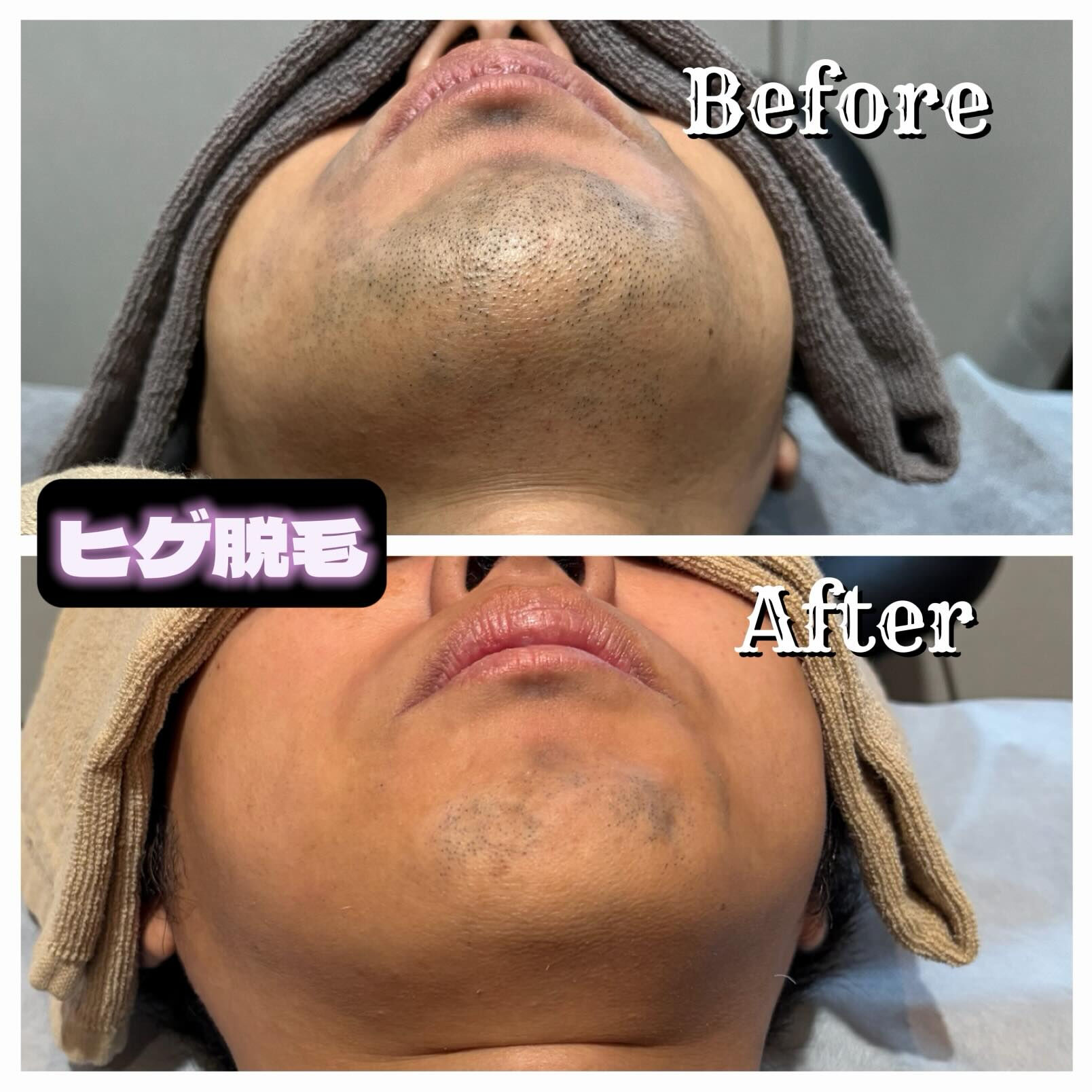 ✨ヒゲ脱毛始めるなら今！✨