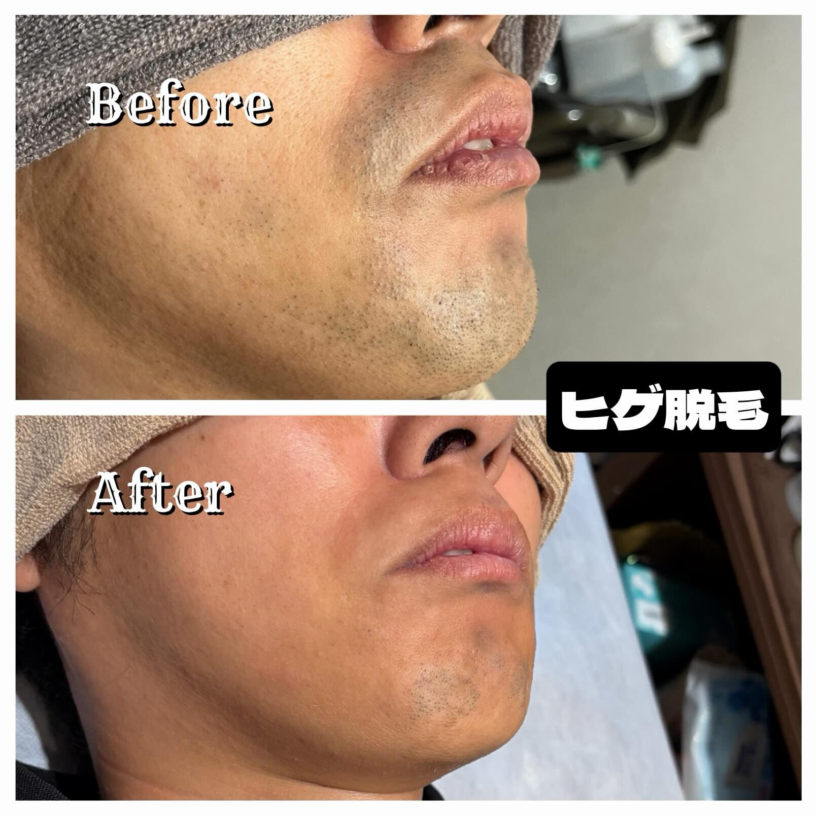 ✨ヒゲ脱毛始めるなら今！✨