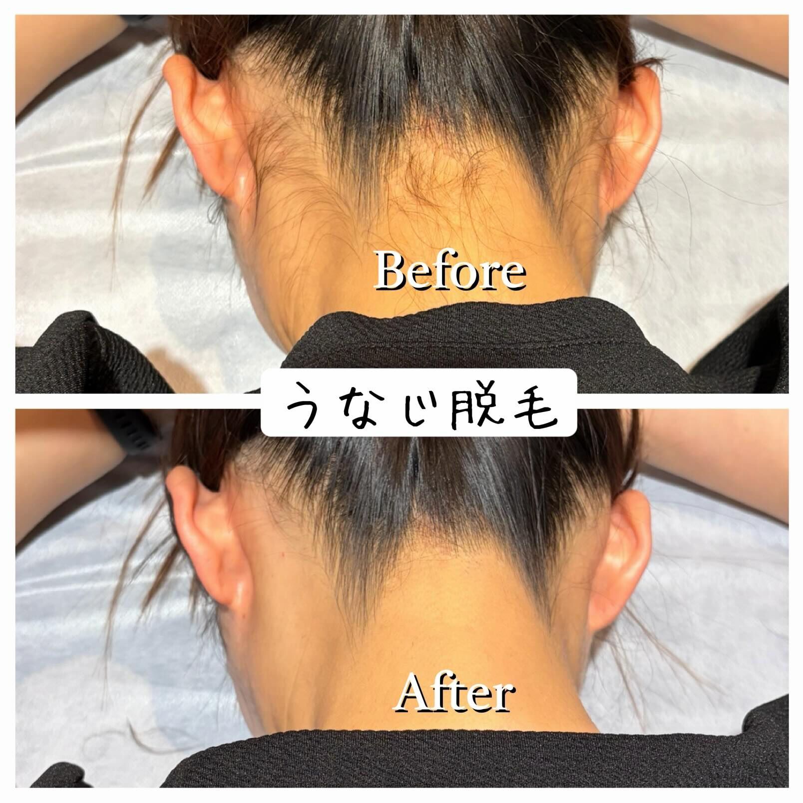 ✨**うなじ脱毛で後ろ姿に自信✨