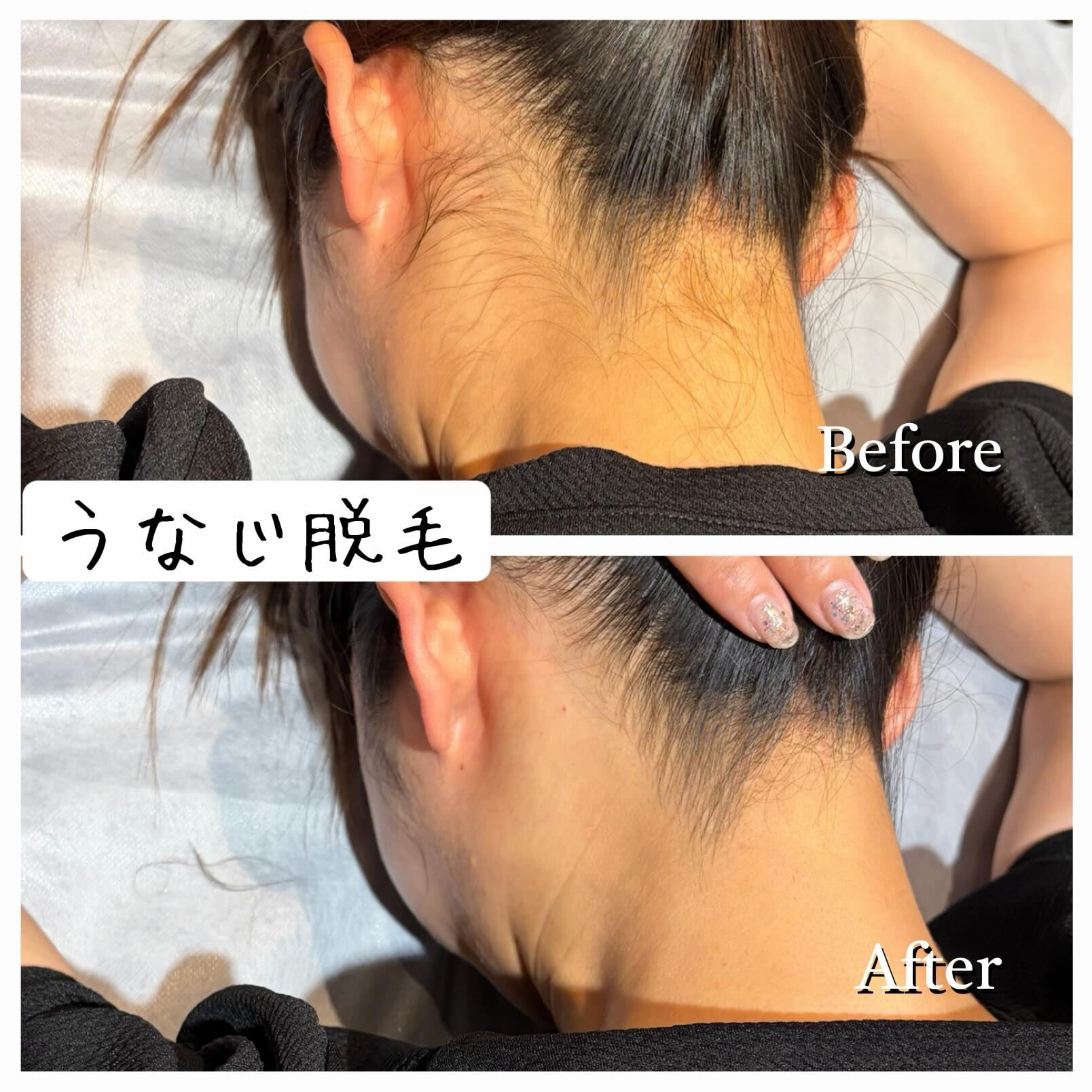 ✨**うなじ脱毛で後ろ姿に自信✨