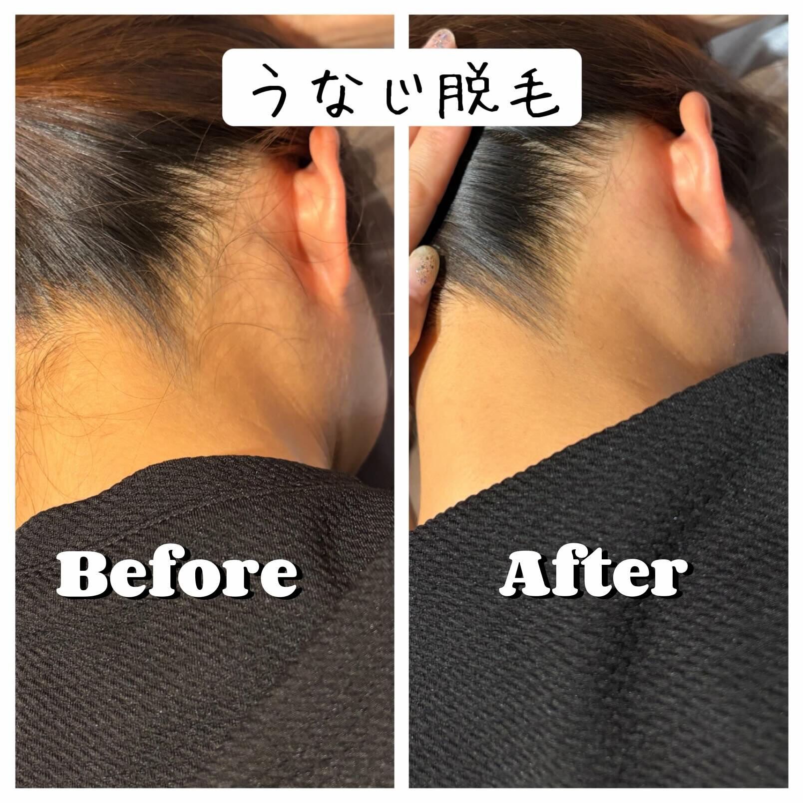 ✨**うなじ脱毛で後ろ姿に自信✨