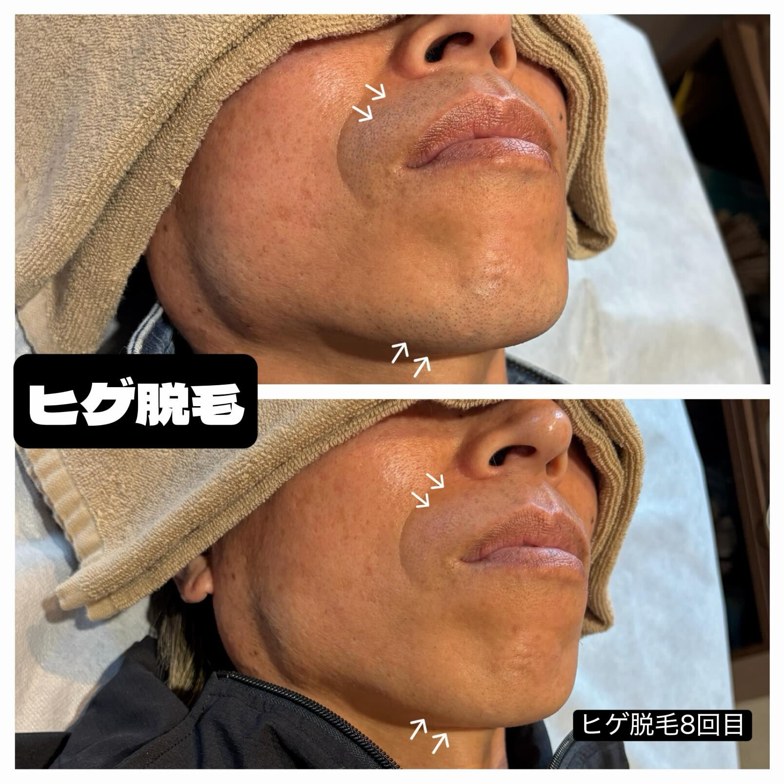 ✨ヒゲ脱毛 Before → After✨
