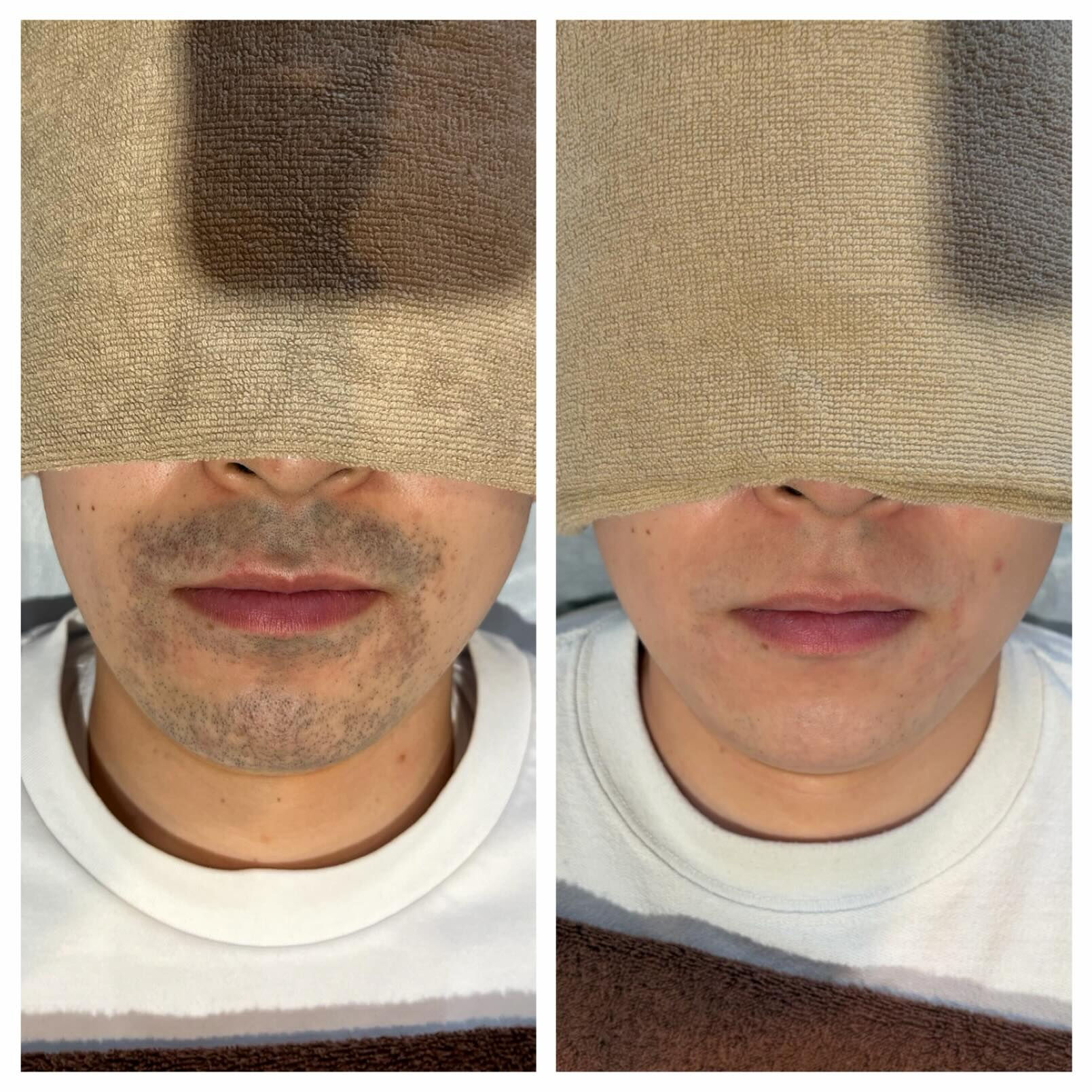 ＼ ヒゲ脱毛 Before → After ／