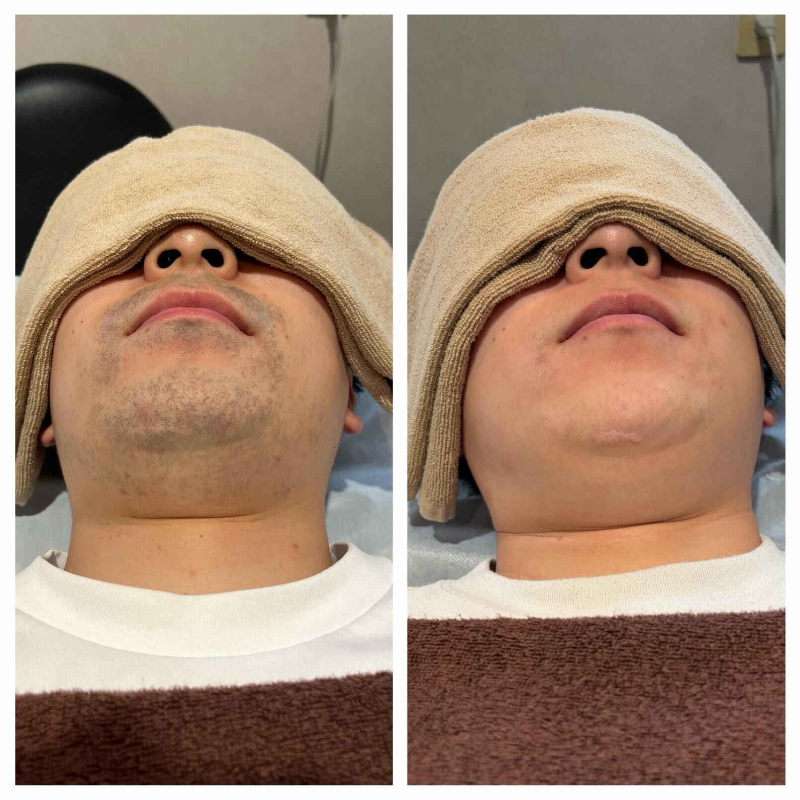 ＼ ヒゲ脱毛 Before → After ／