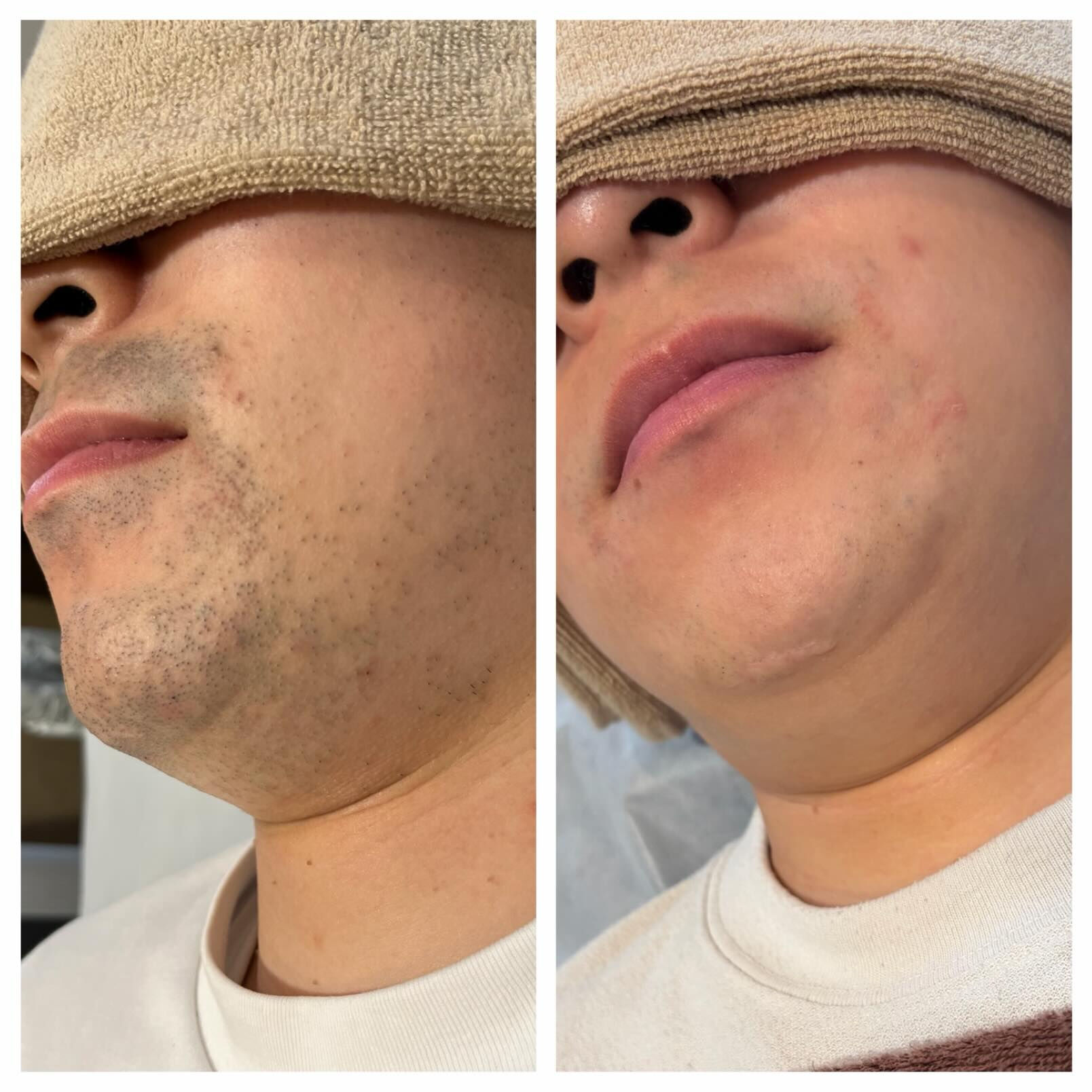 ＼ ヒゲ脱毛 Before → After ／