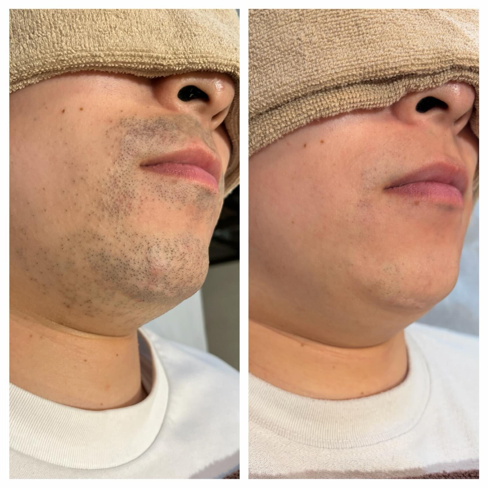 ＼ ヒゲ脱毛 Before → After ／
