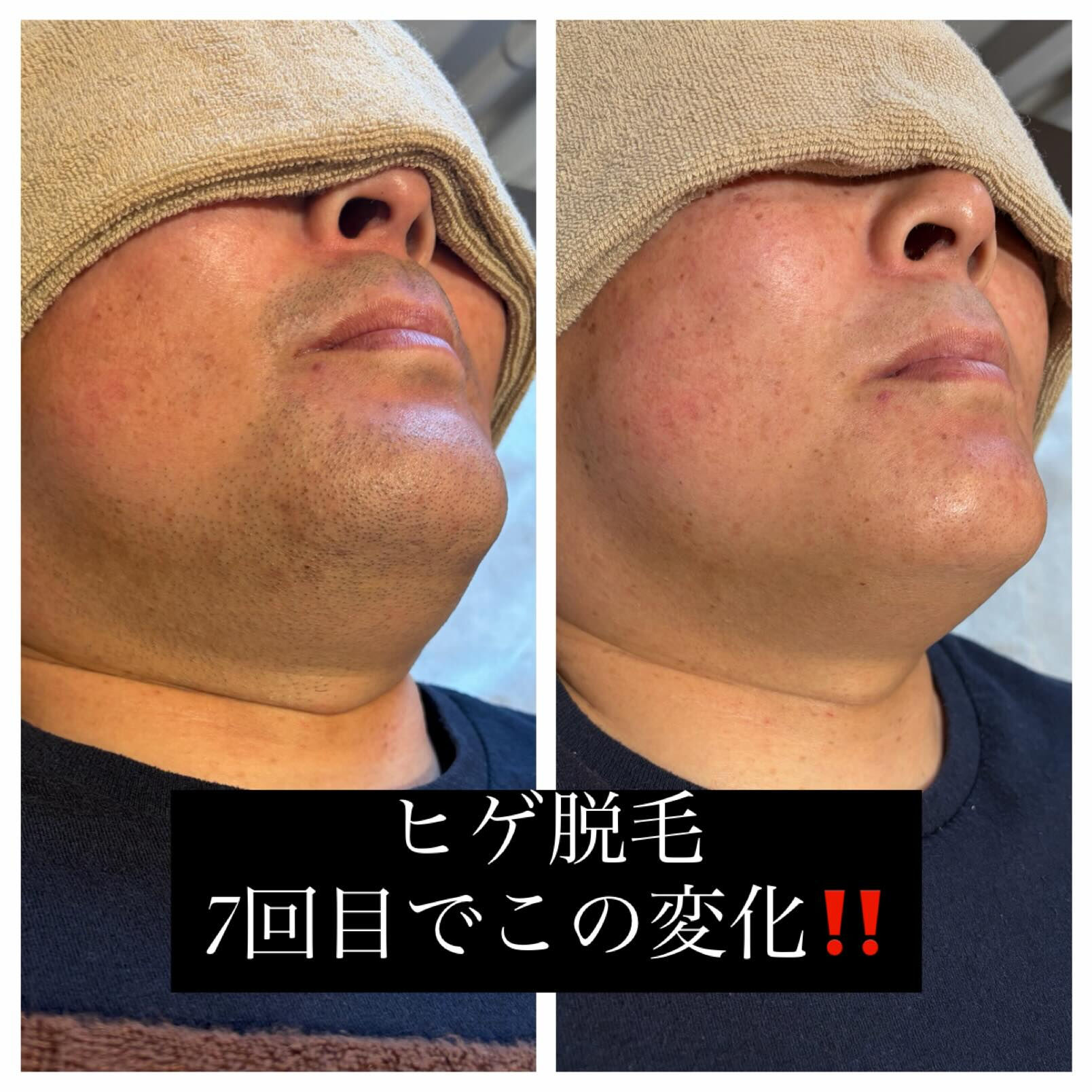 大人気のヒゲ脱毛🥸