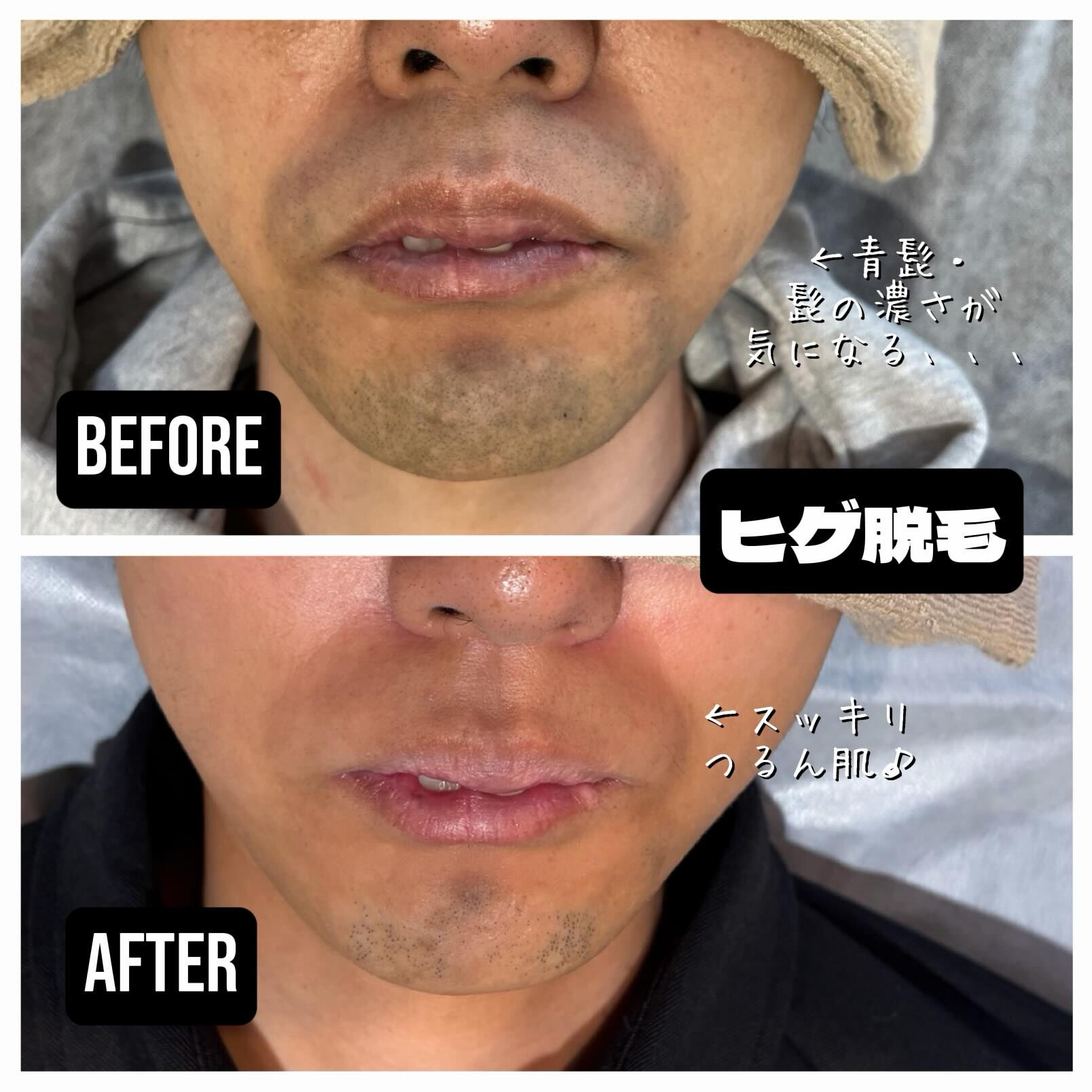 ヒゲ脱毛は