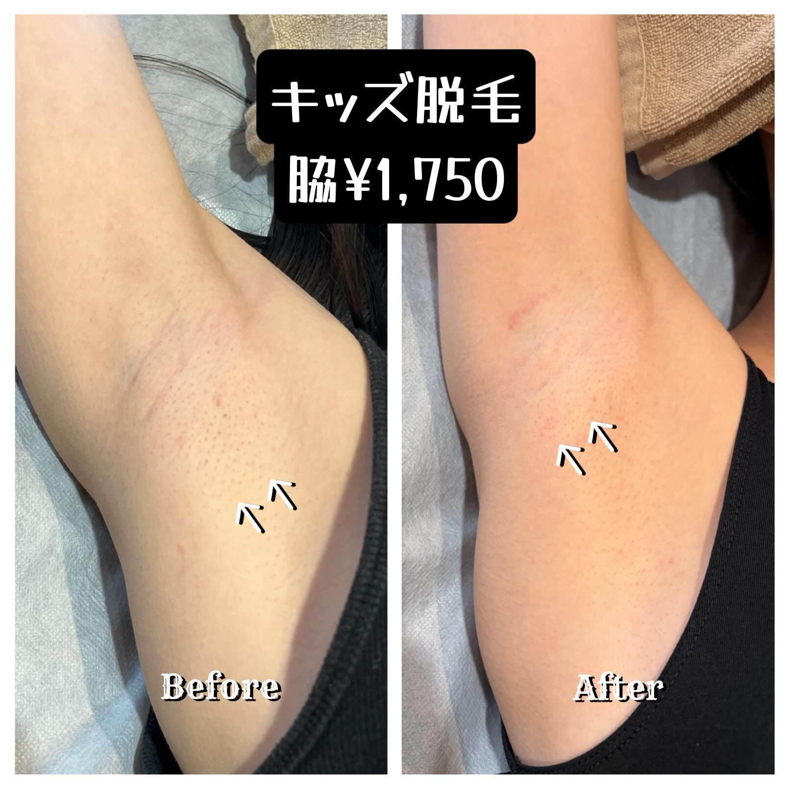 🌿 お子さまのムダ毛、気になっていませんか？