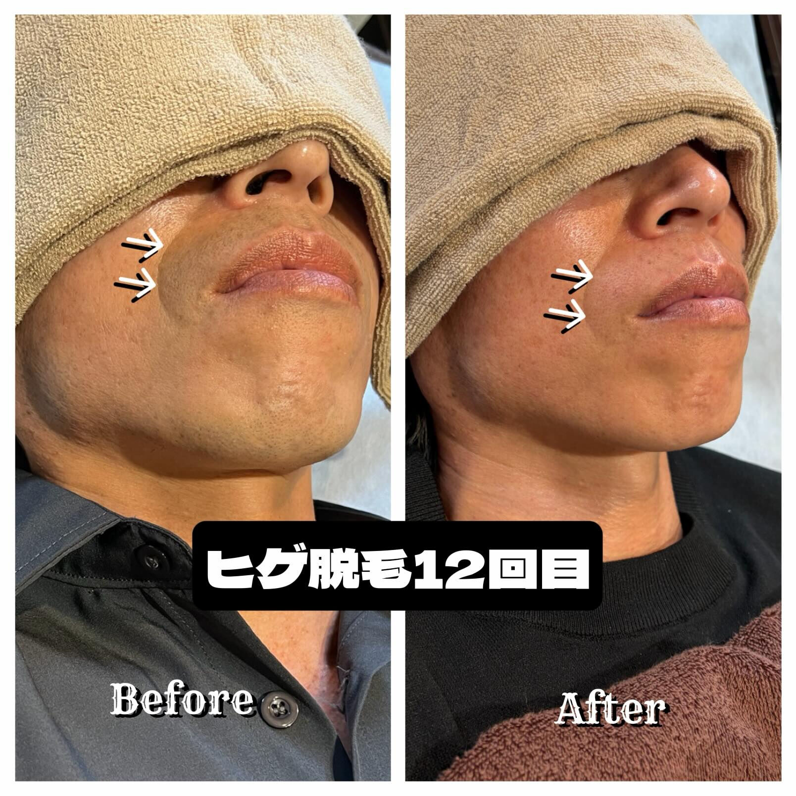 🧔🏻‍♂️ そのヒゲ剃り、毎日続けますか？