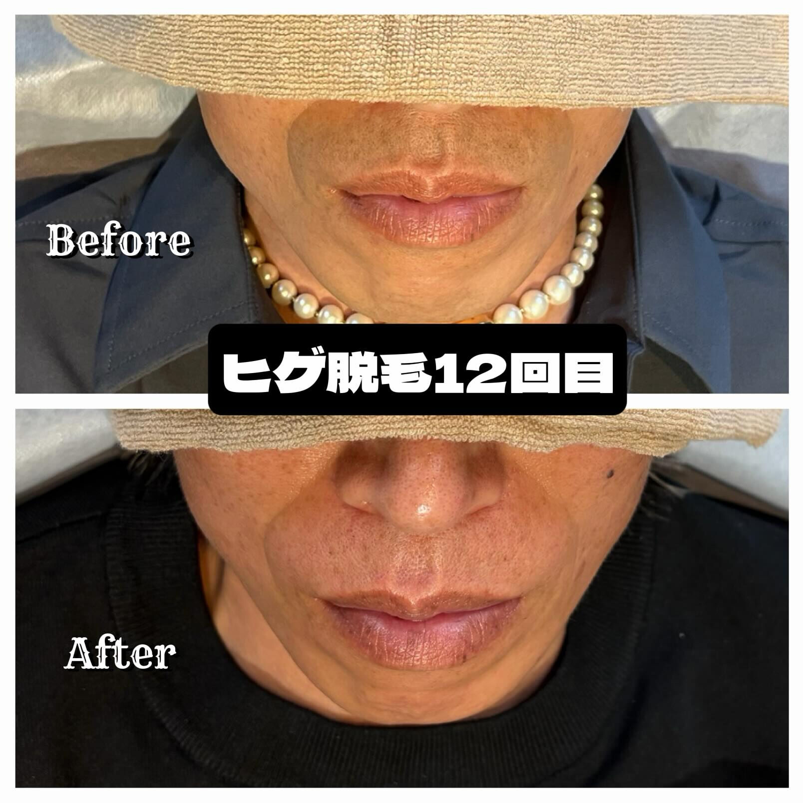 🧔🏻‍♂️ そのヒゲ剃り、毎日続けますか？