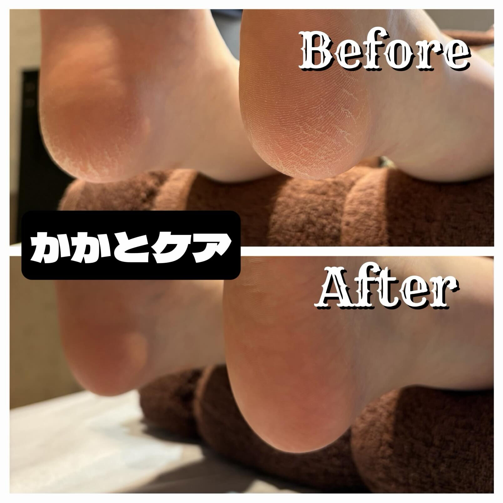 🦶✨ ガサガサかかと、卒業しませんか？