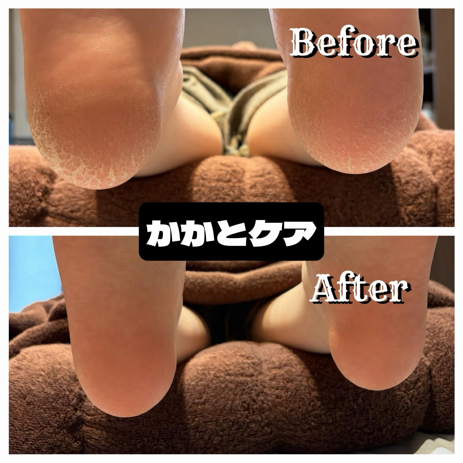 🦶✨ ガサガサかかと、卒業しませんか？